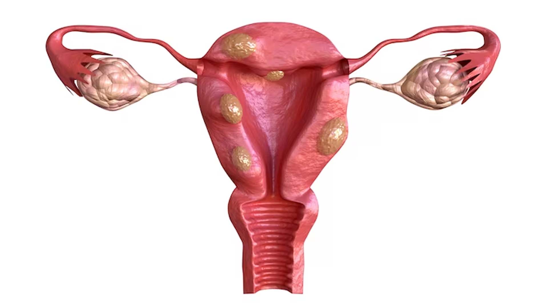 Uterine Fibroids