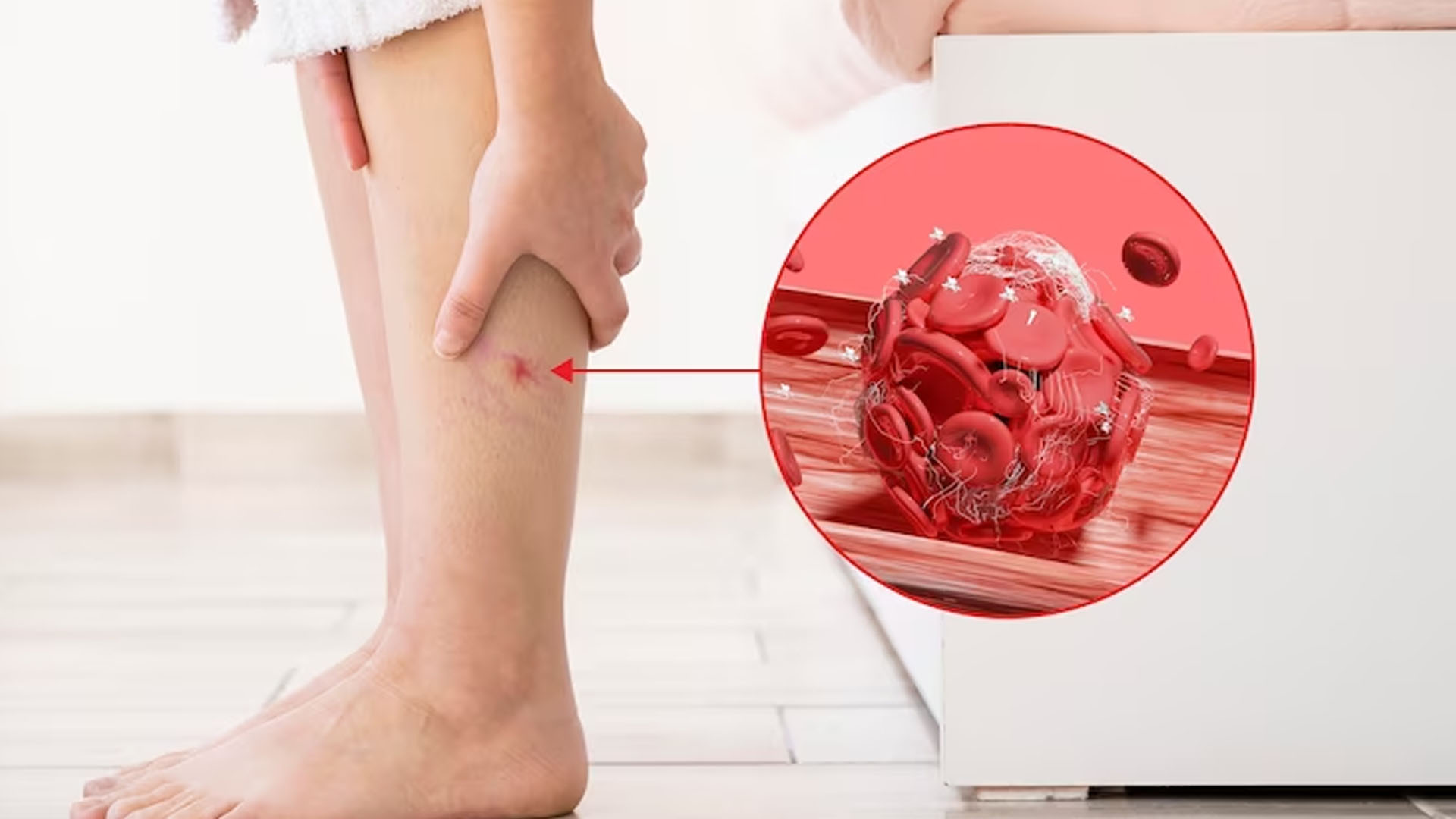What are the Home Remedies to treat Varicose Veins?