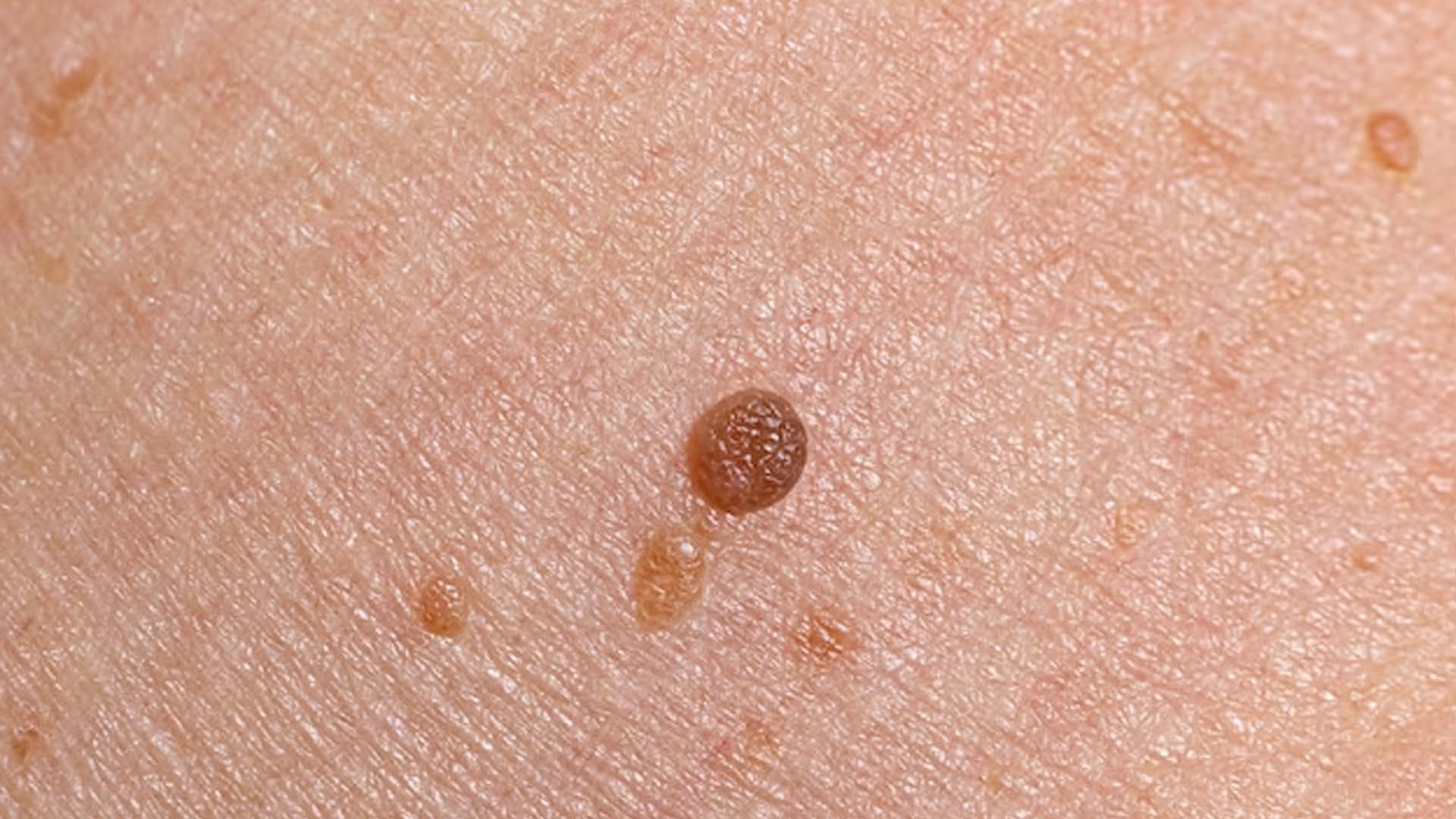 Warts