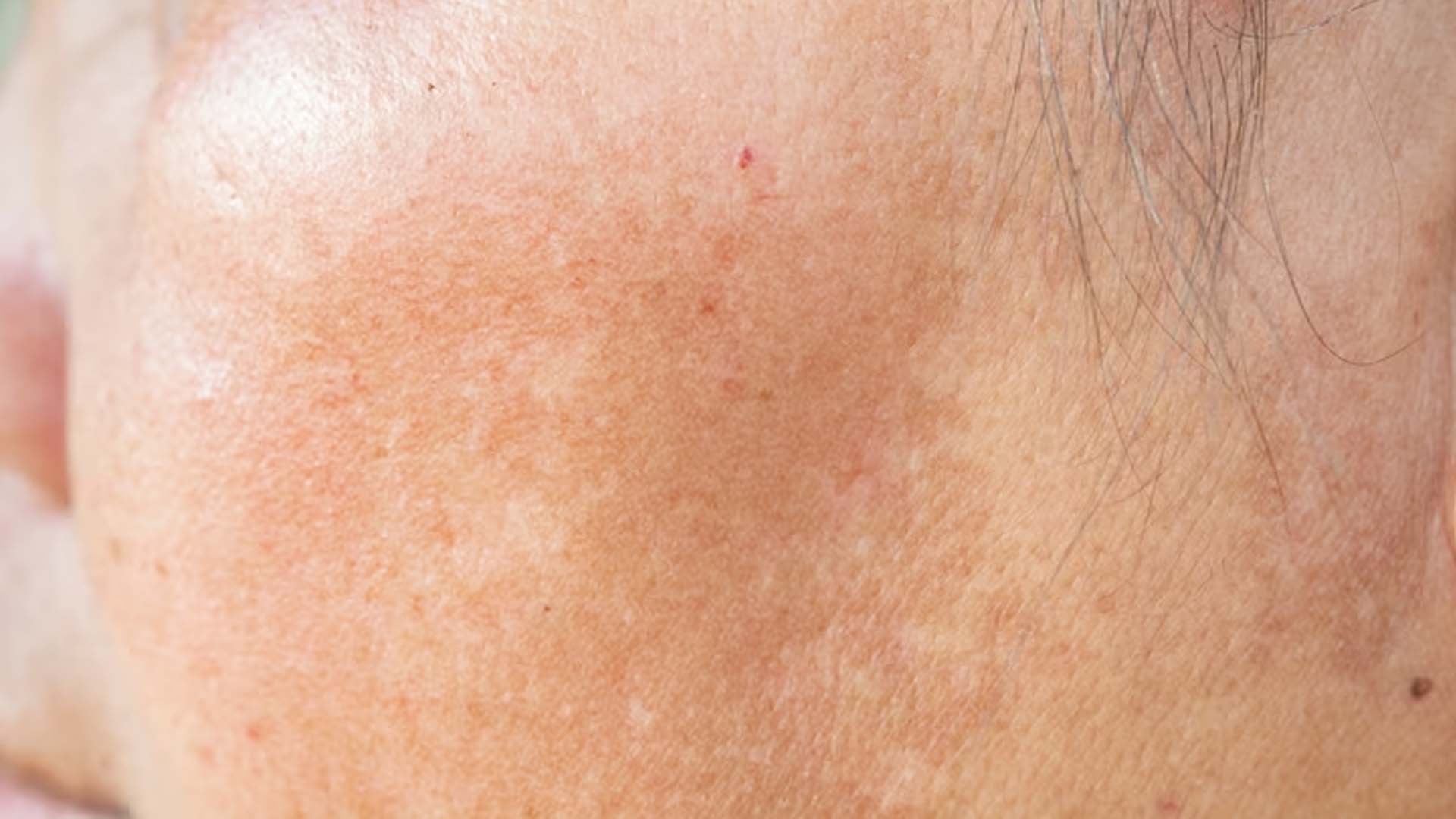 White Spots on Skin