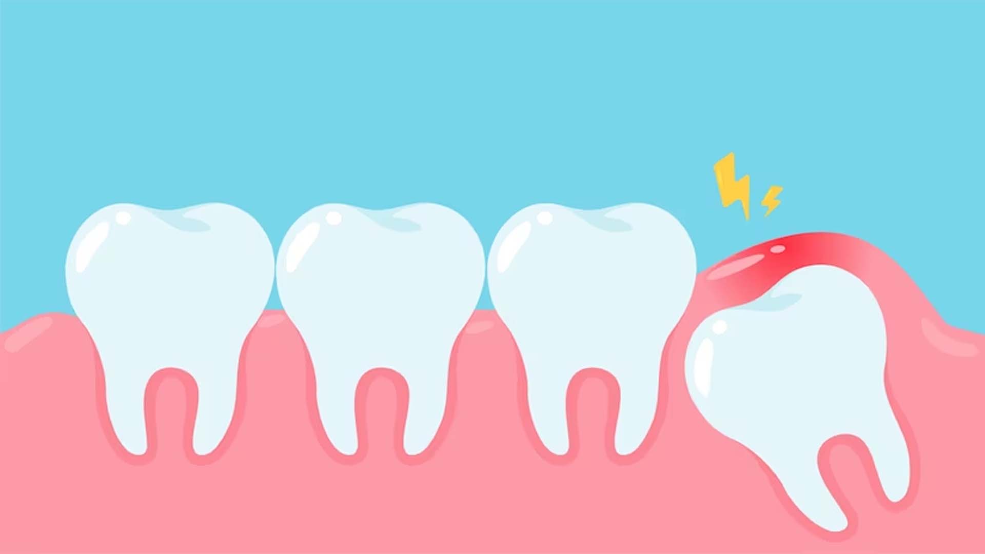 Wisdom Teeth
