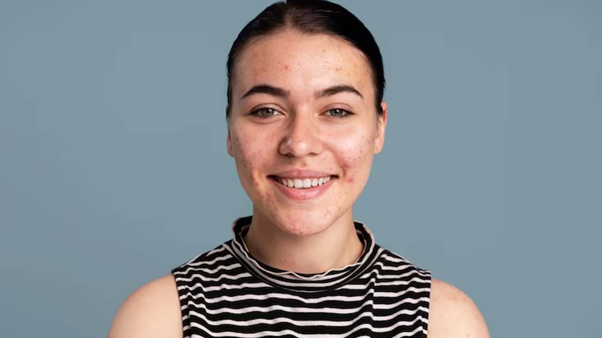 Acne face