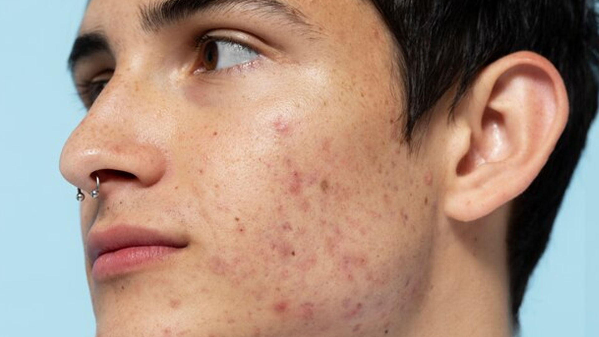 What are the Home Remedies for Open Pores?