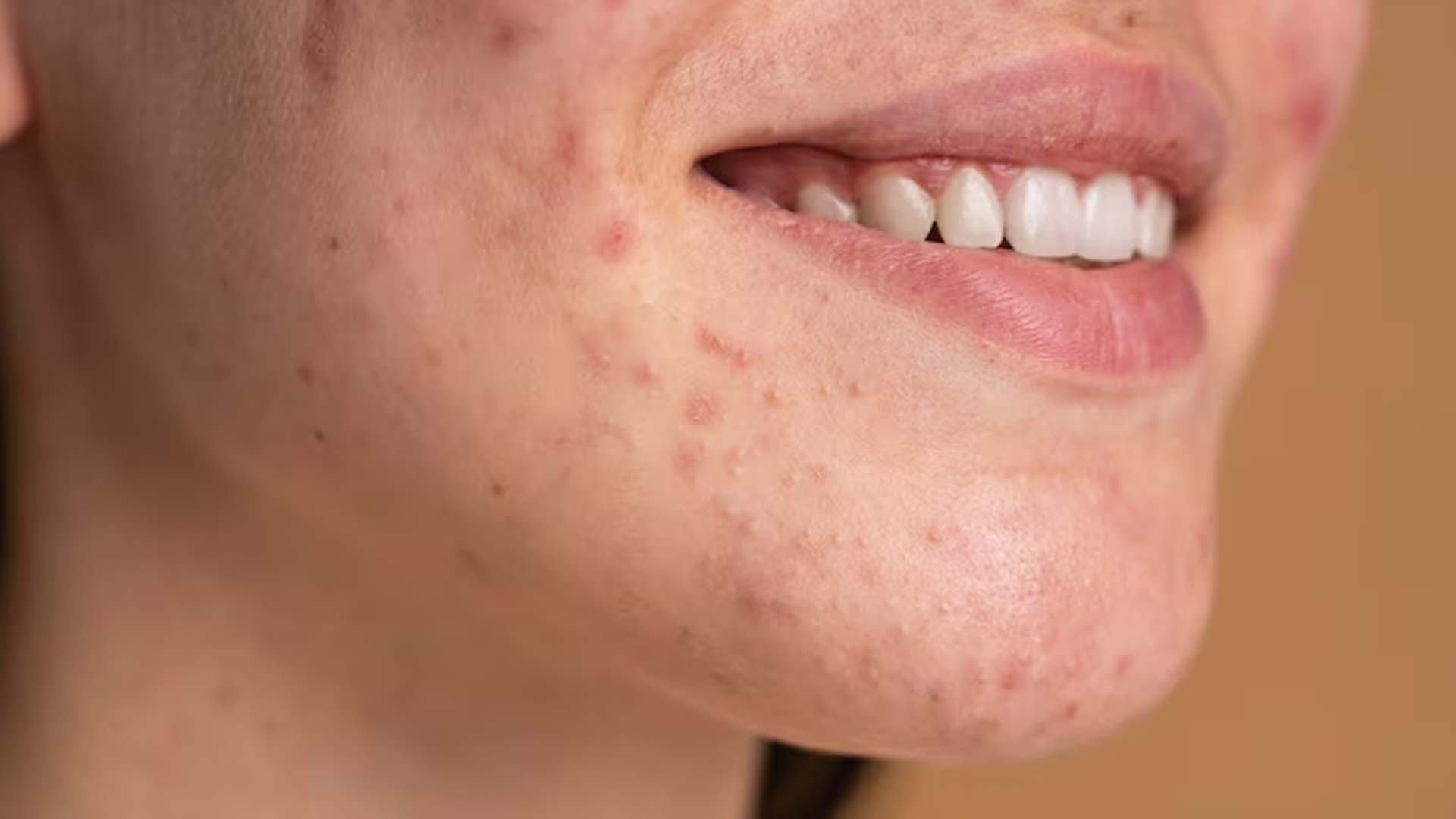 Acne Around Mouth