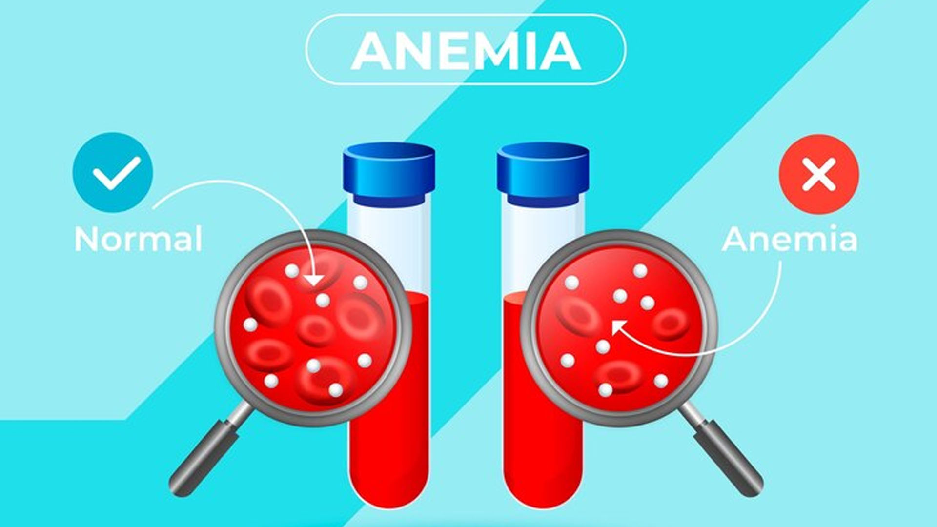 What are the Home Remedies for Anemia?