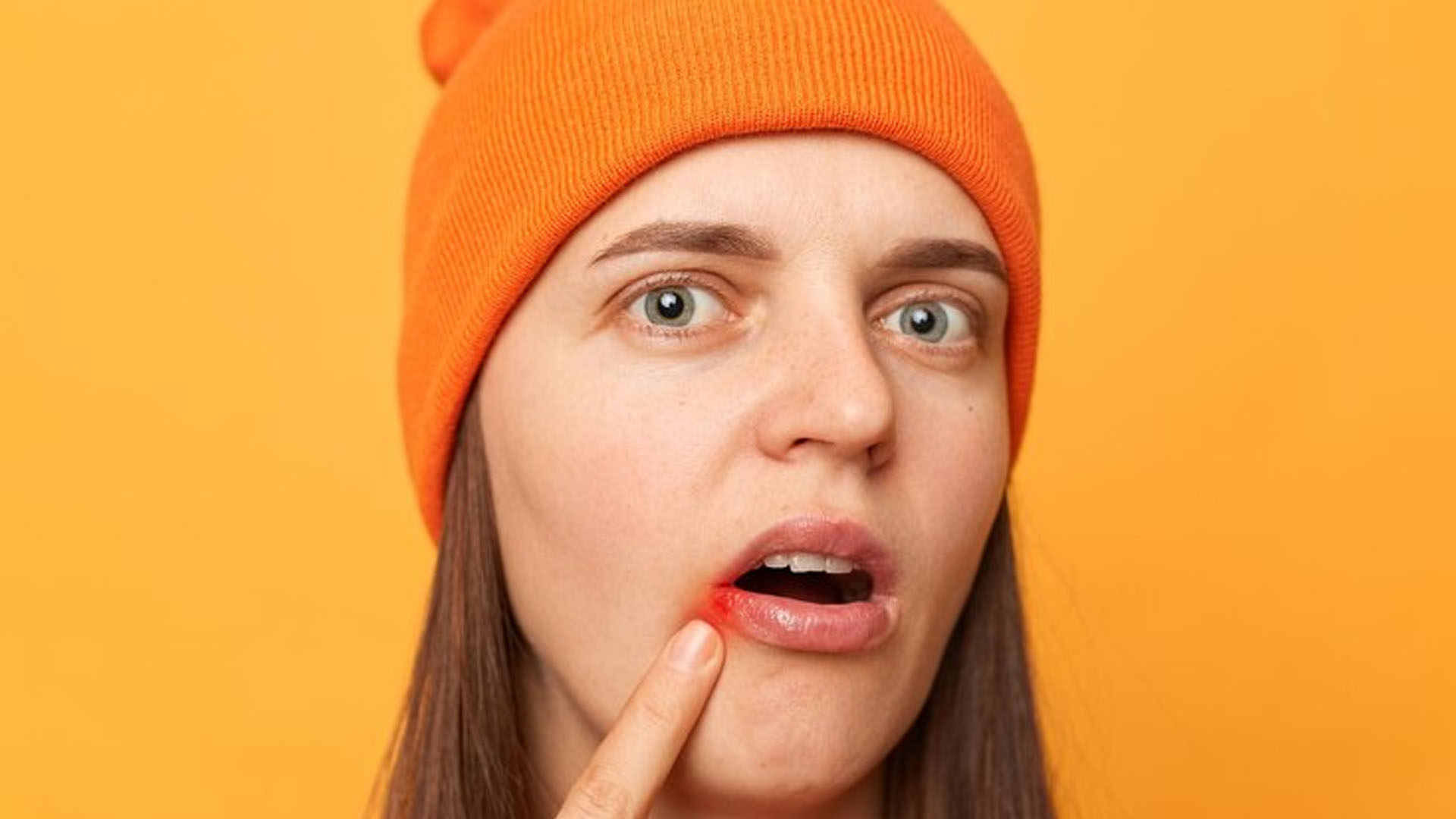 What are the Home Remedies for Angular cheilitis?