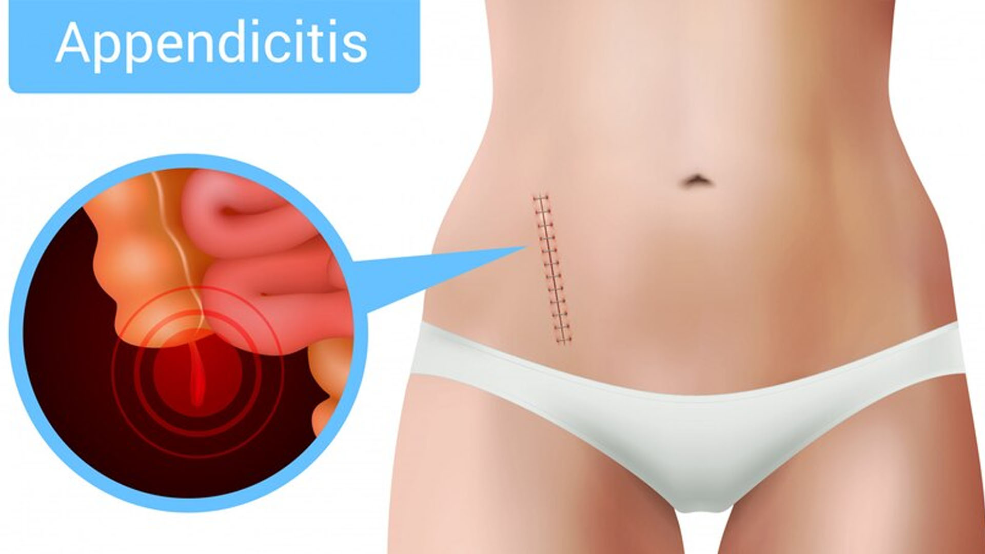 What are the Home Remedies for Appendicitis?