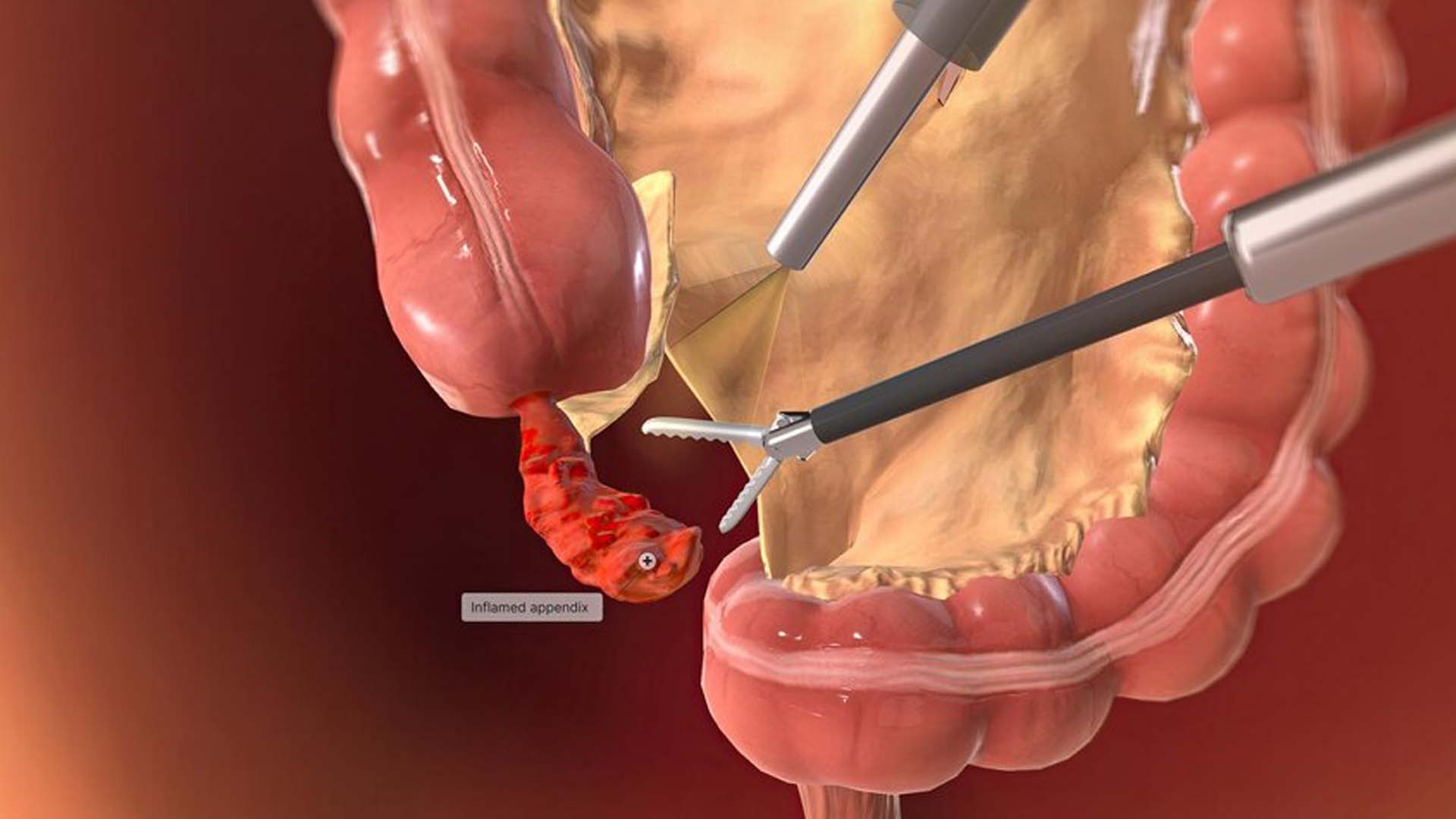 Appendix Surgery