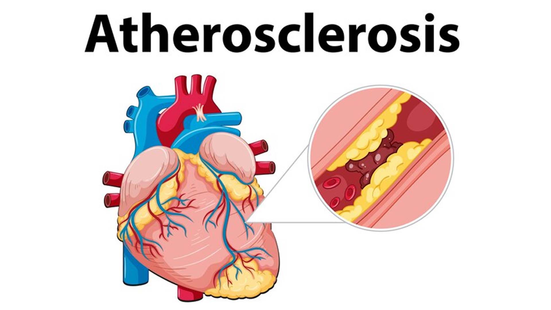 Atherosclerosis