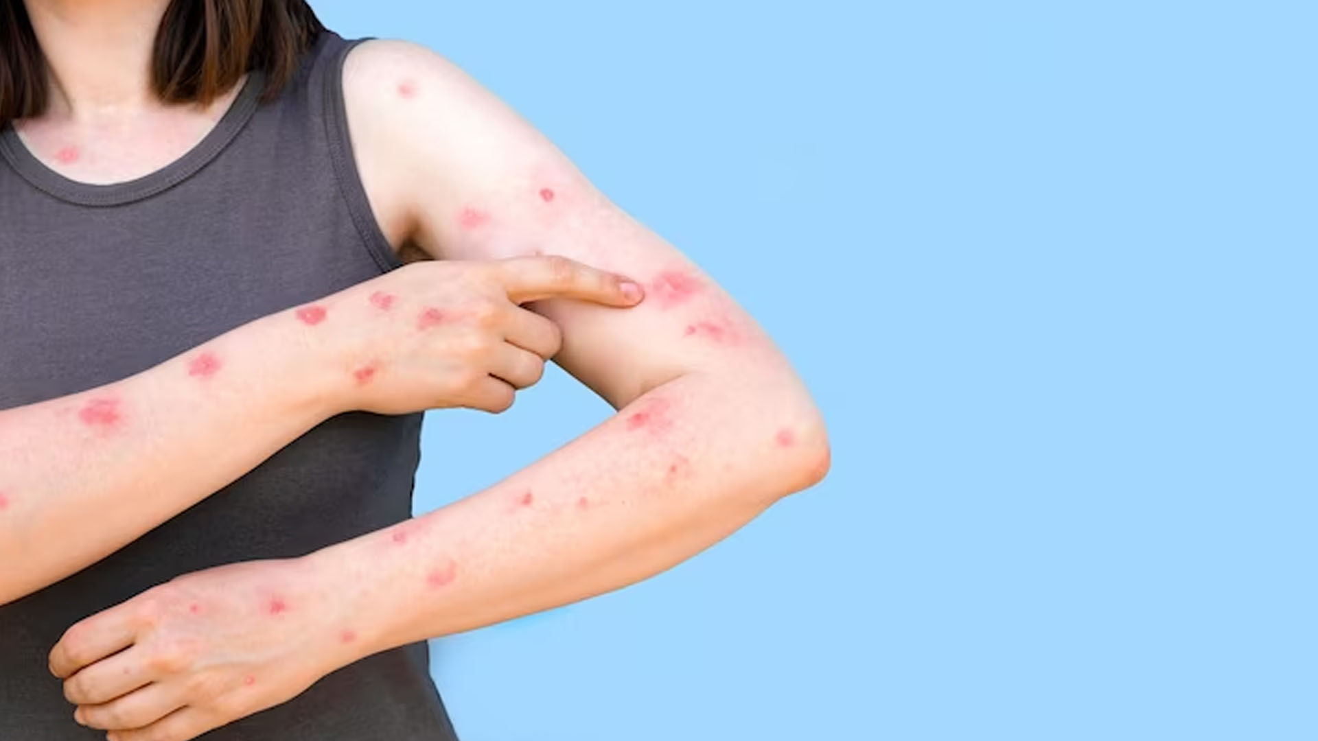 What are the Home Remedies for Atopic Dermatitis?