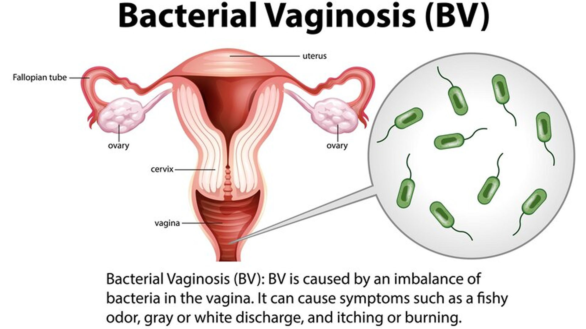What are the Home Remedies for Bacterial Vaginosis?