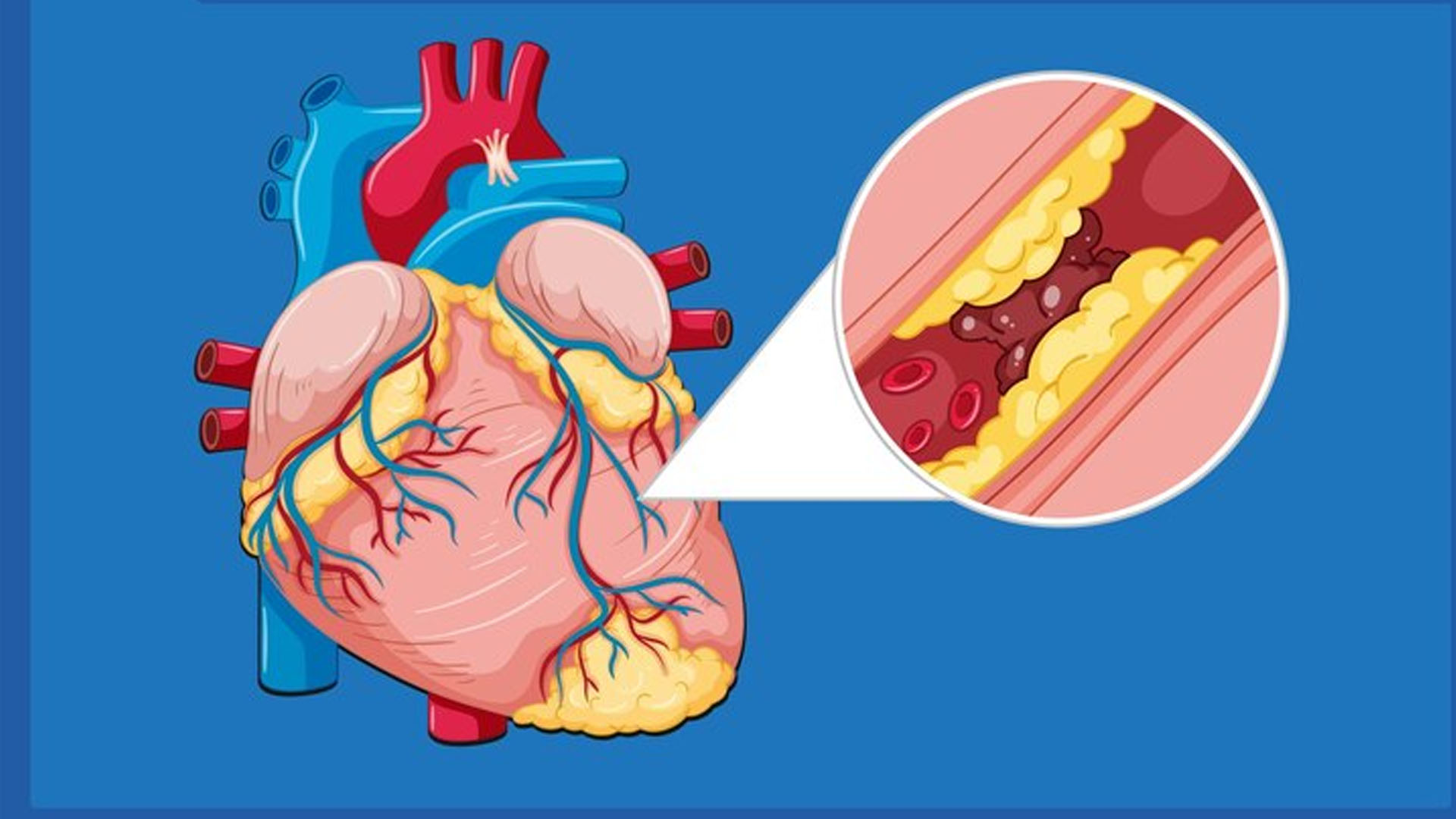 What are the Home Remedies for Bad Cholesterol?