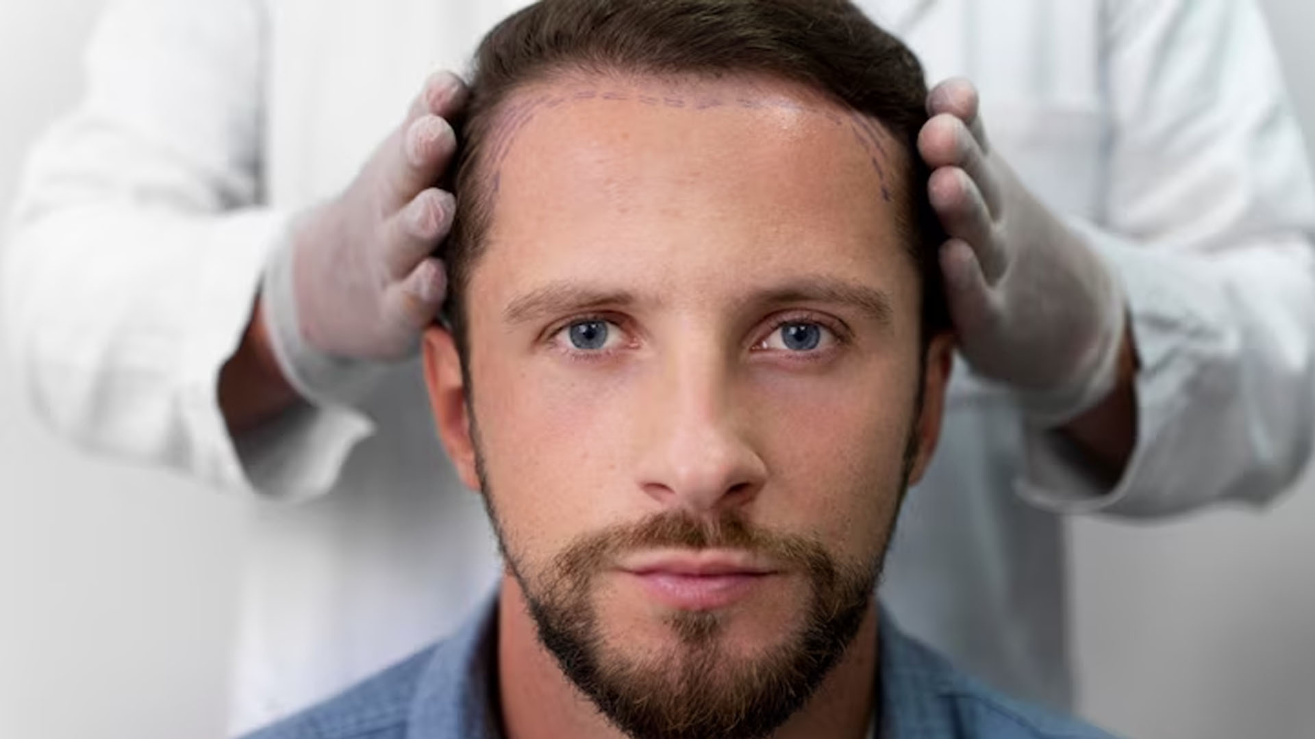 What are the Home Remedies for Baldness?