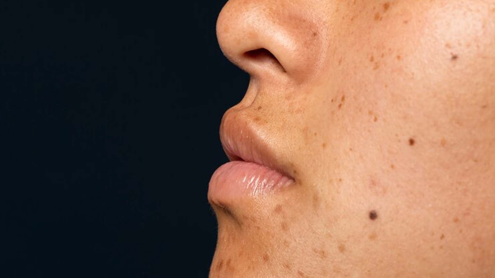 Beauty Marks or Moles