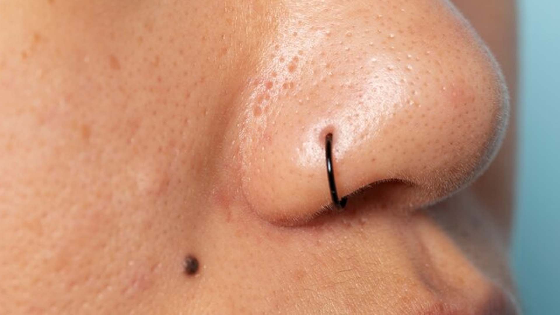 Black Moles