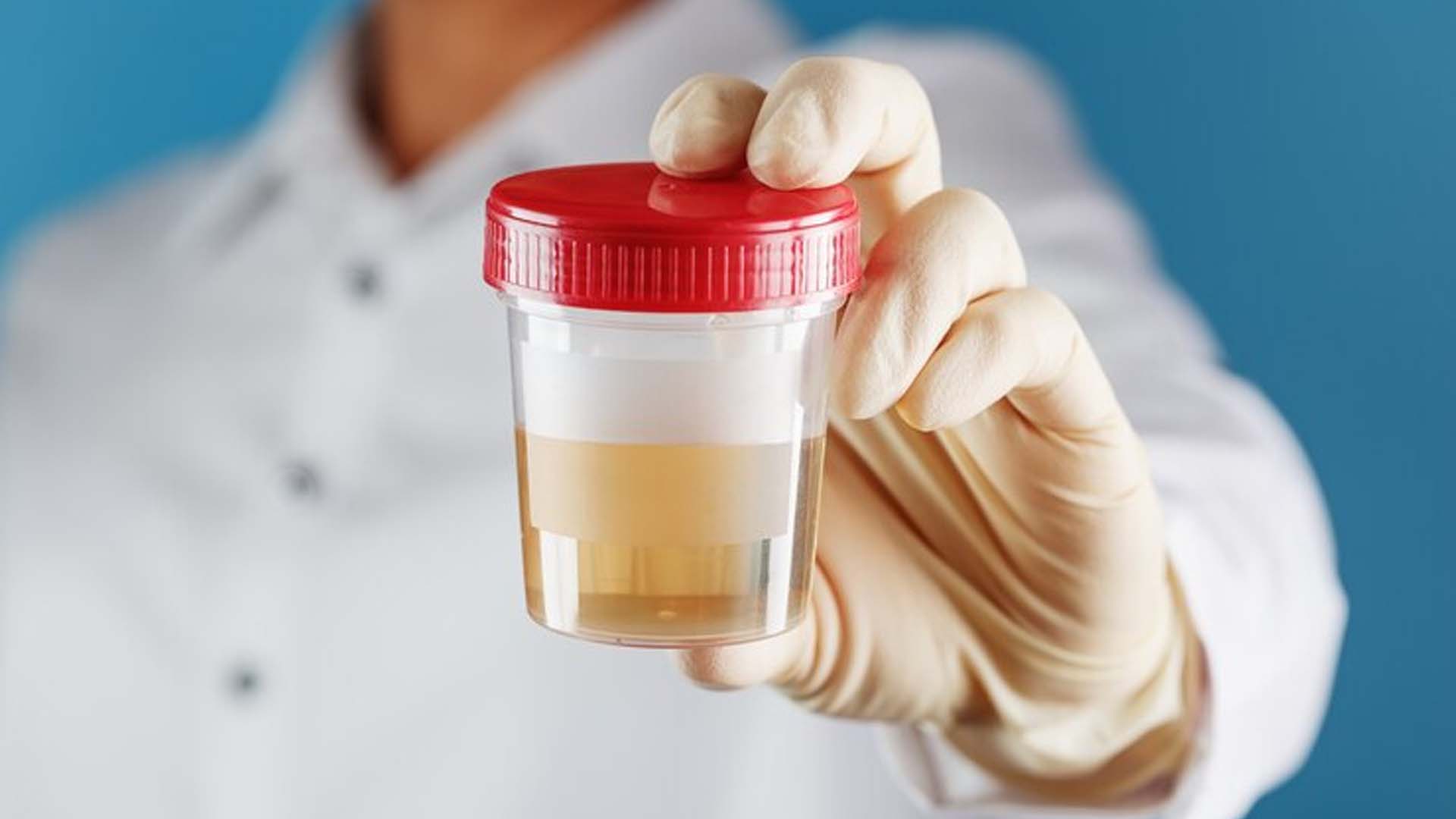 Blood in Urine