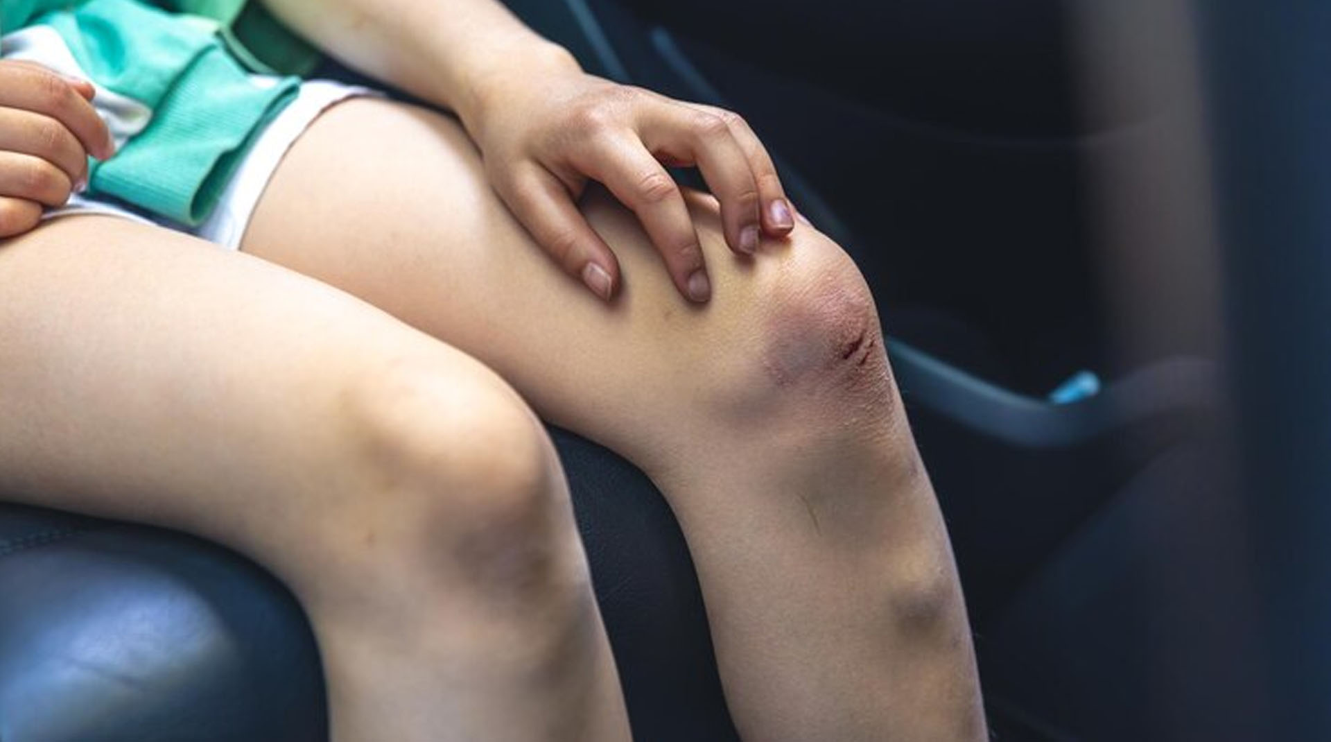What are the Home Remedies for Bruises?