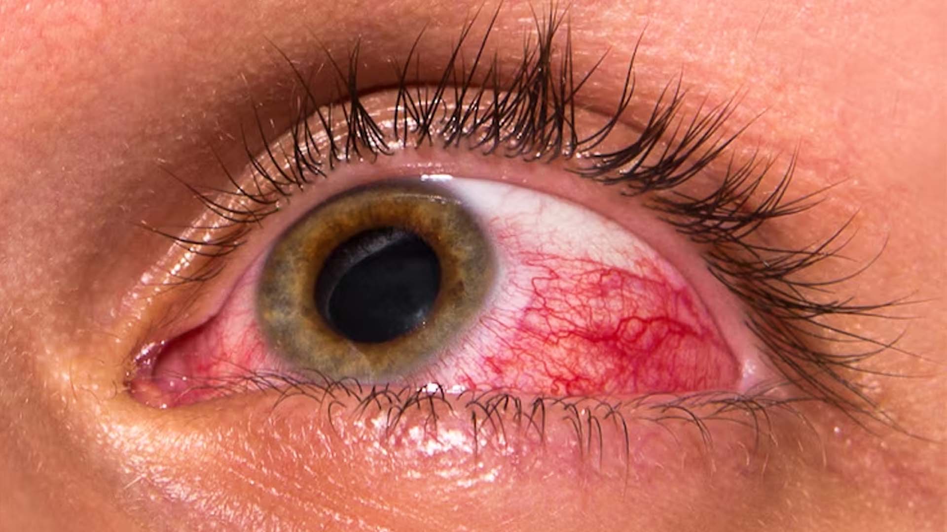 A burst blood vessel in the eye