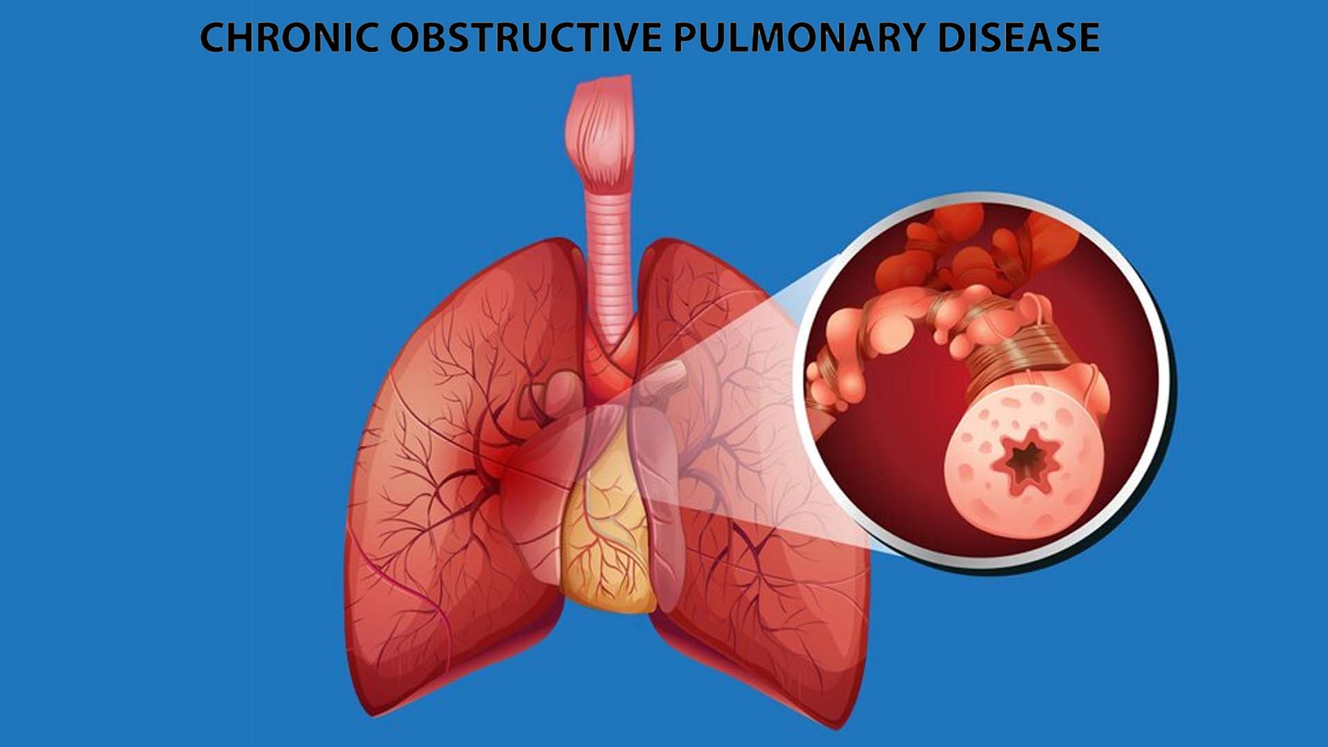 Chronic Obstructive Pulmonary Disease (COPD)