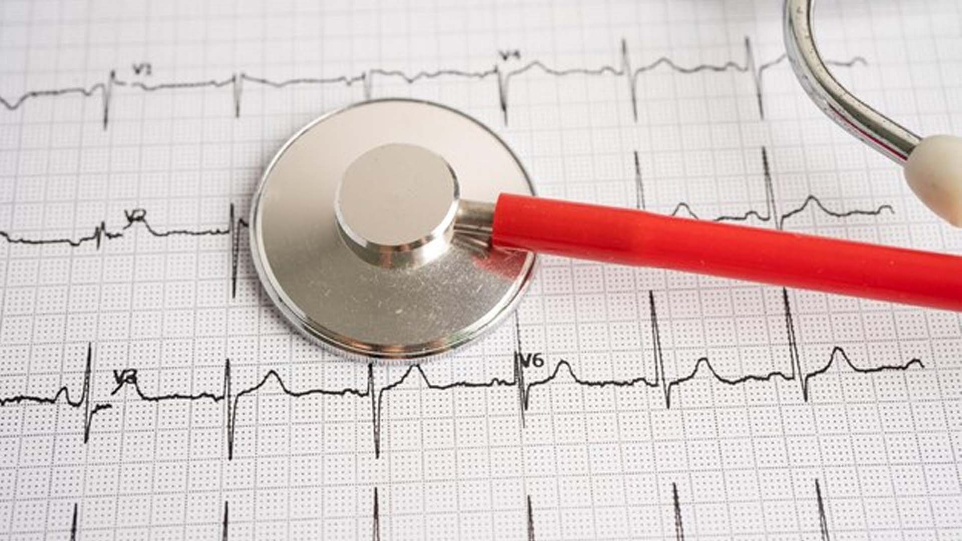 arrhythmia