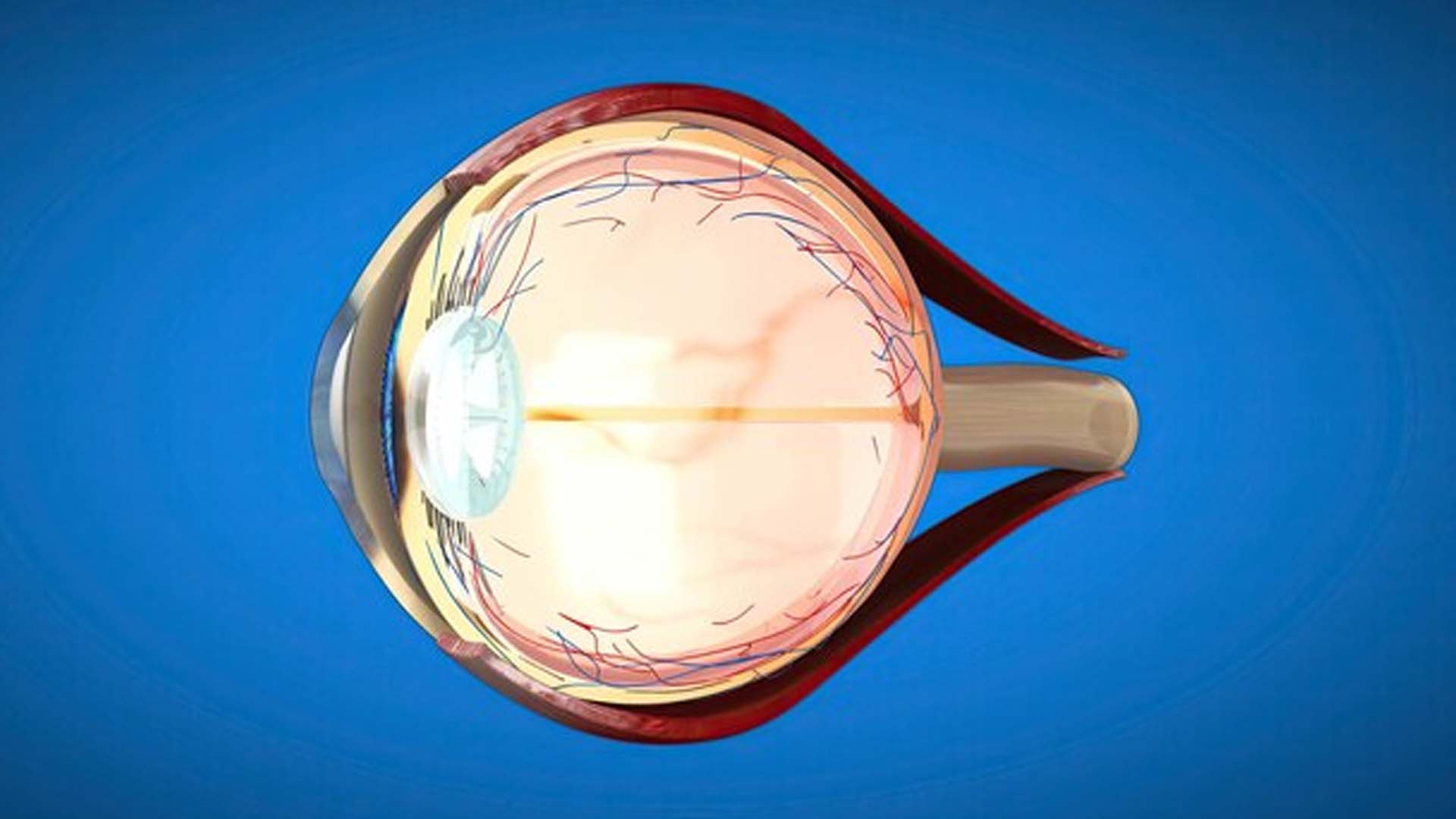 What are the Home Remedies for Cataracts?