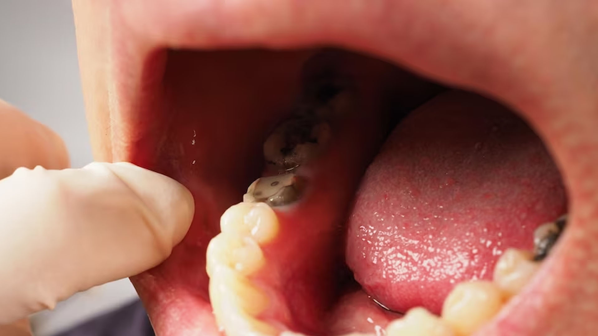 What are the Home Remedies for Cavities?