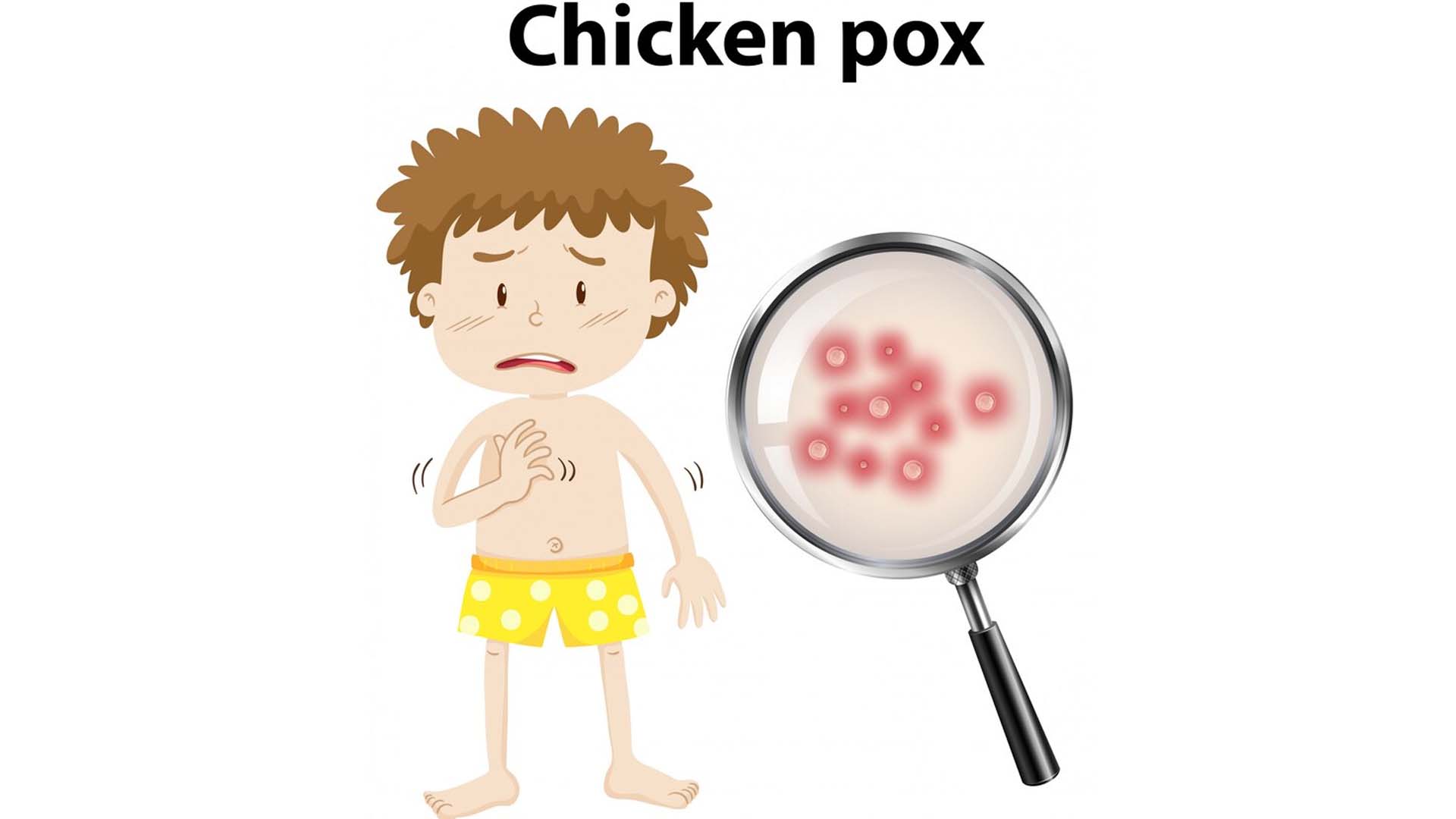 Chickenpox