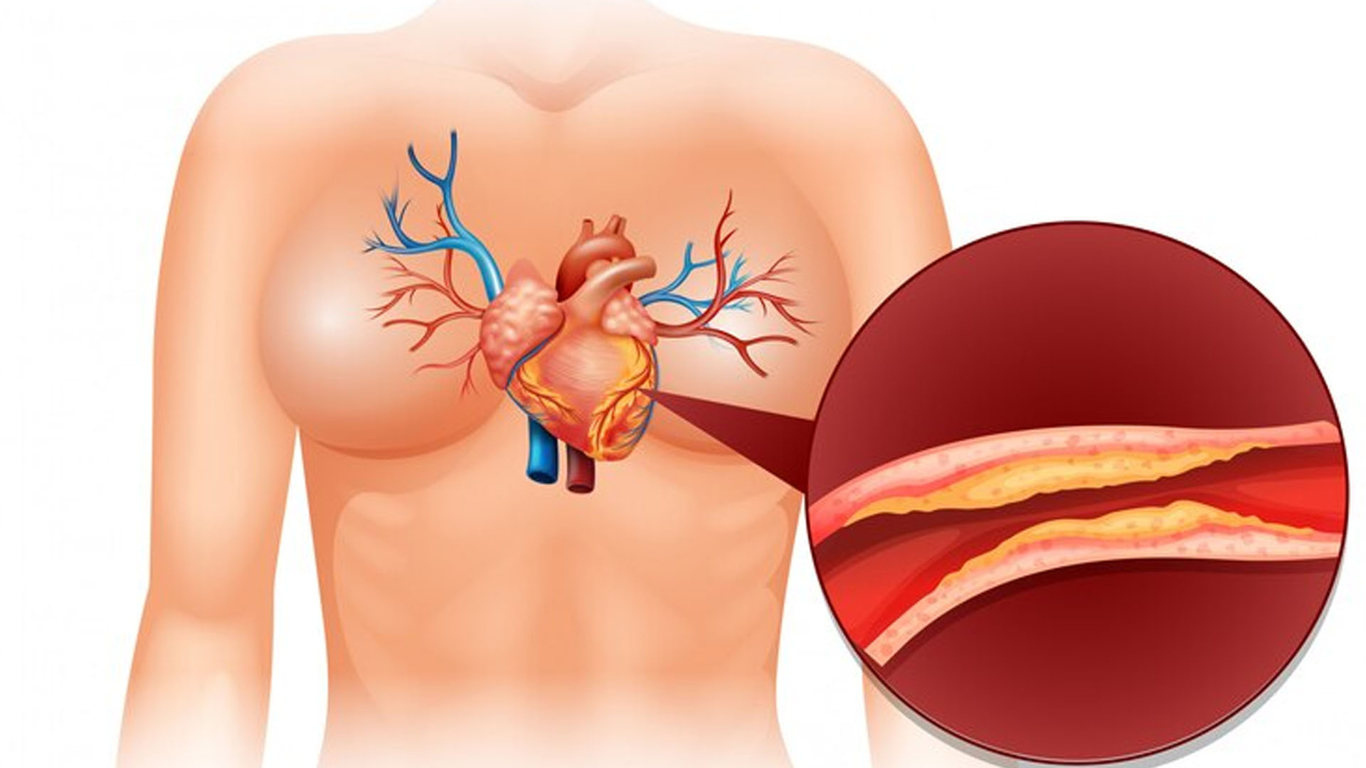 What are the Home Remedies to control Cholesterol?