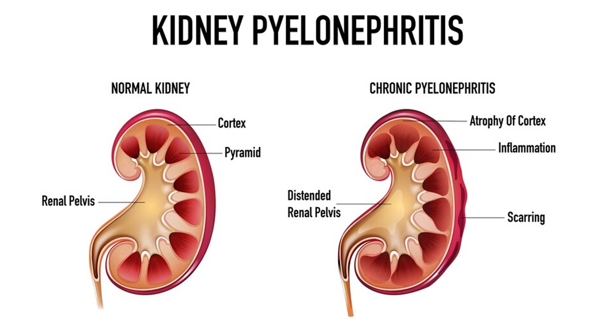 Chronic Pyelonephritis