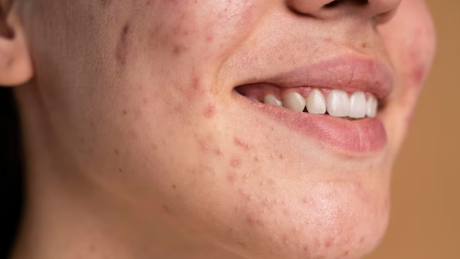What are the Home Remedies for Clogged Pores?