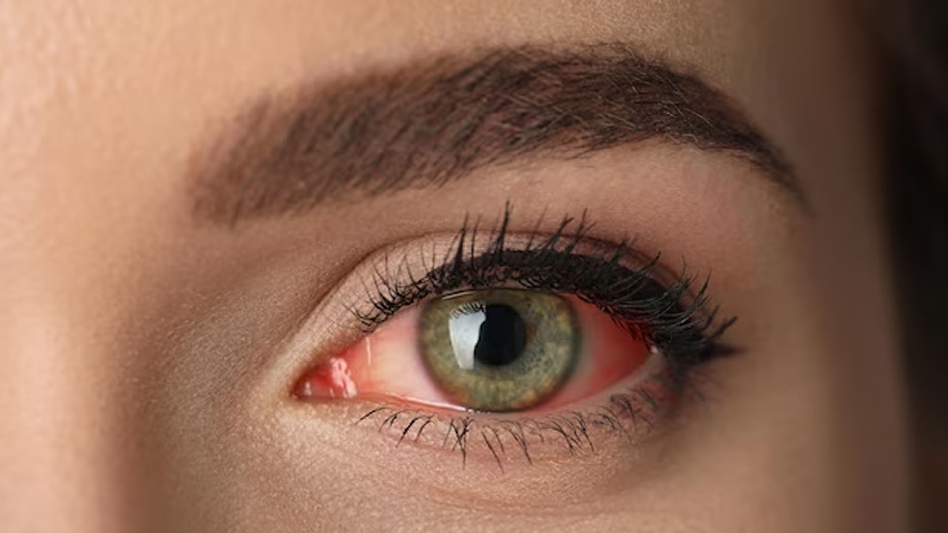 What are the Home Remedies for Conjuctivitis?