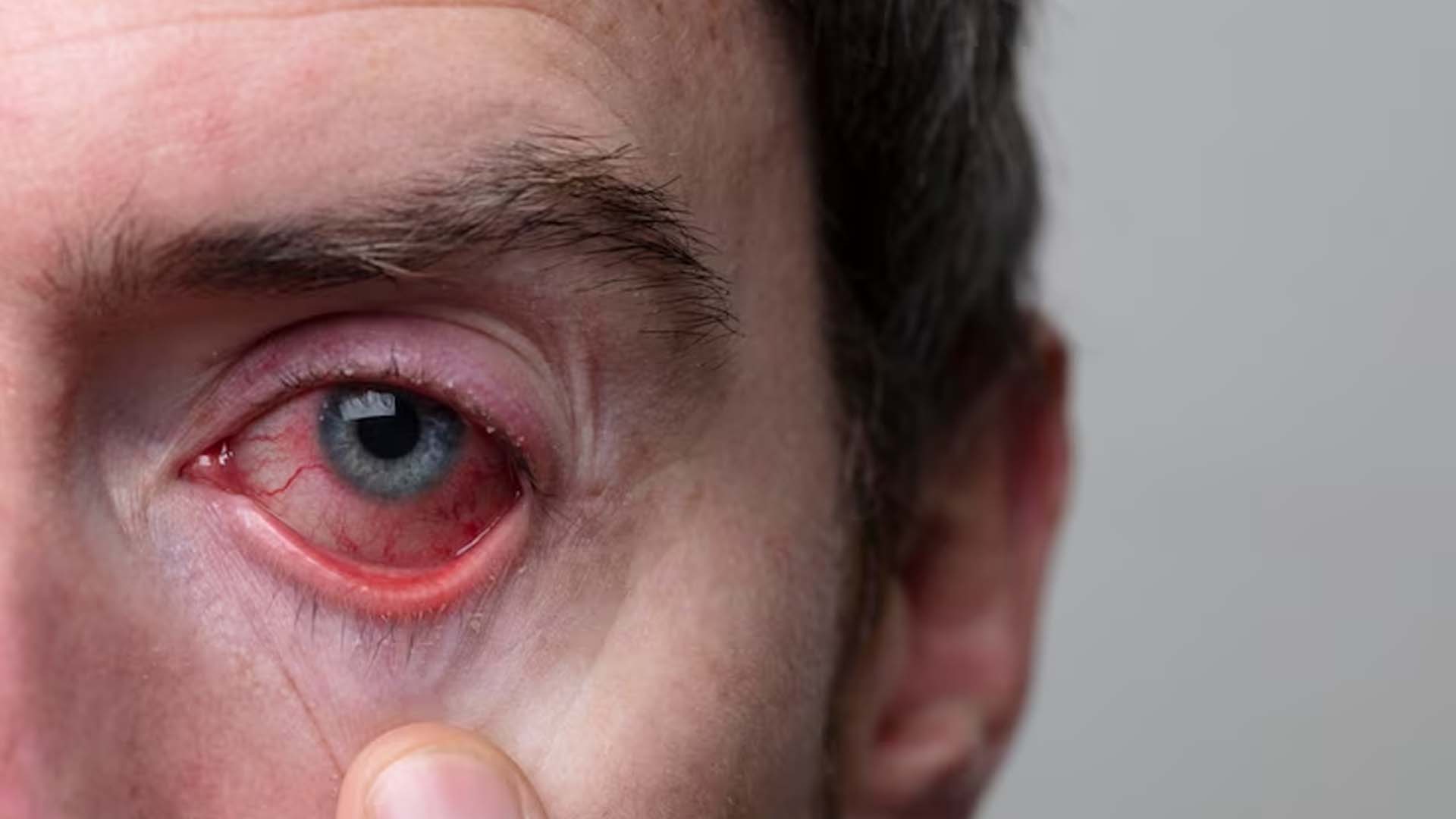 Conjunctivitis or Pink eye