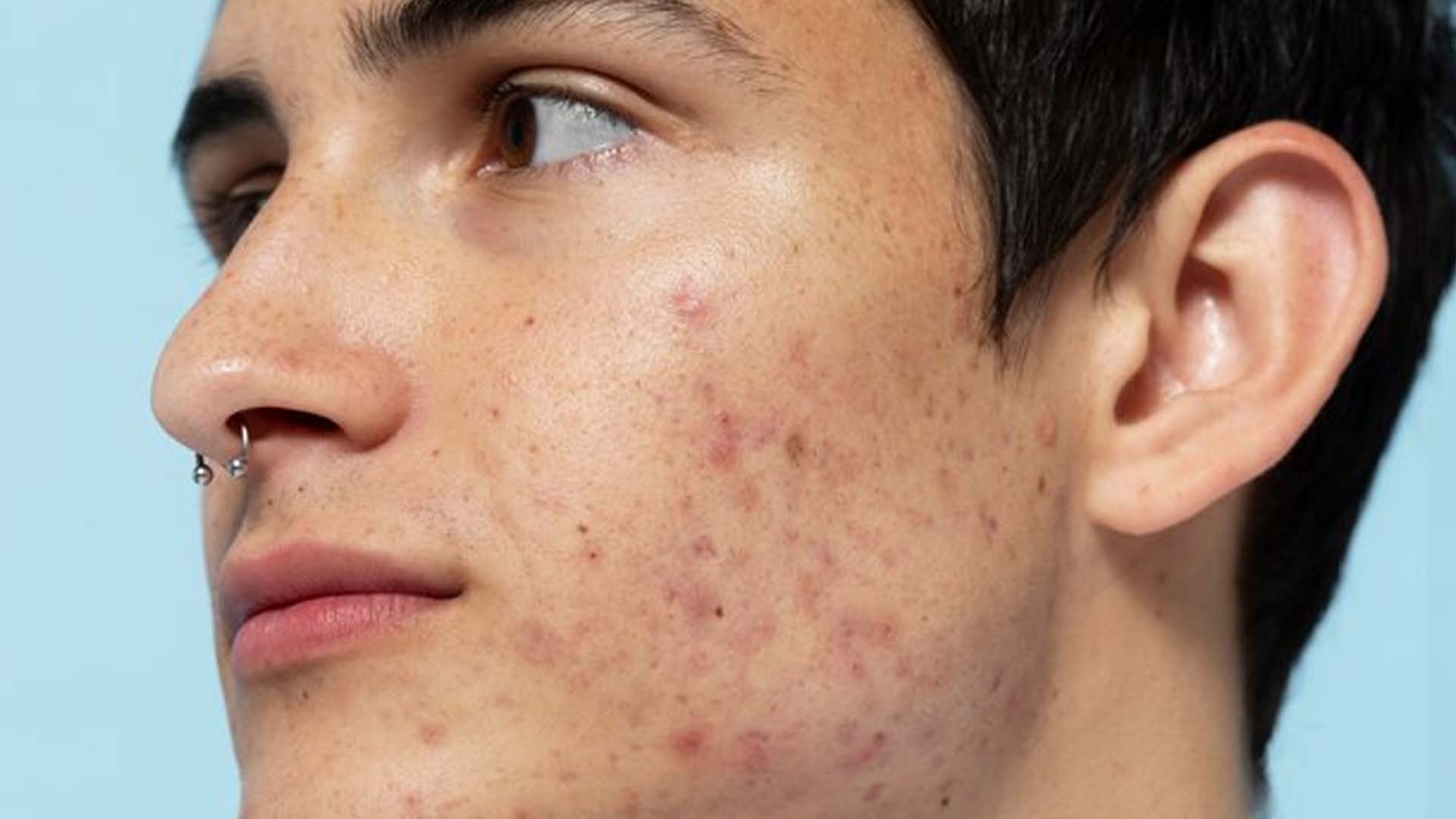 What are the Home Remedies to treat Cystic Acne?
