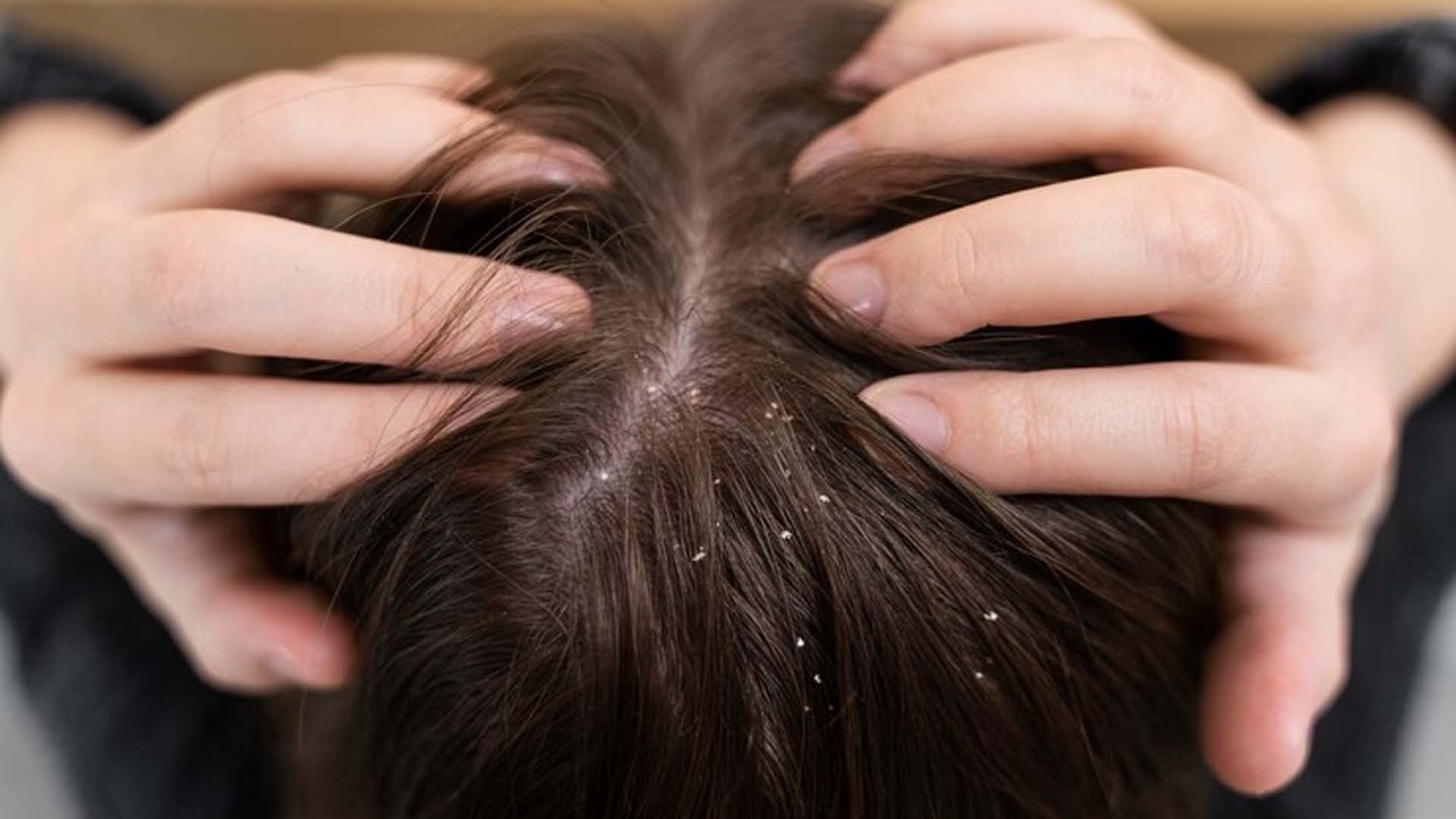 Dandruff and an itchy scalp
