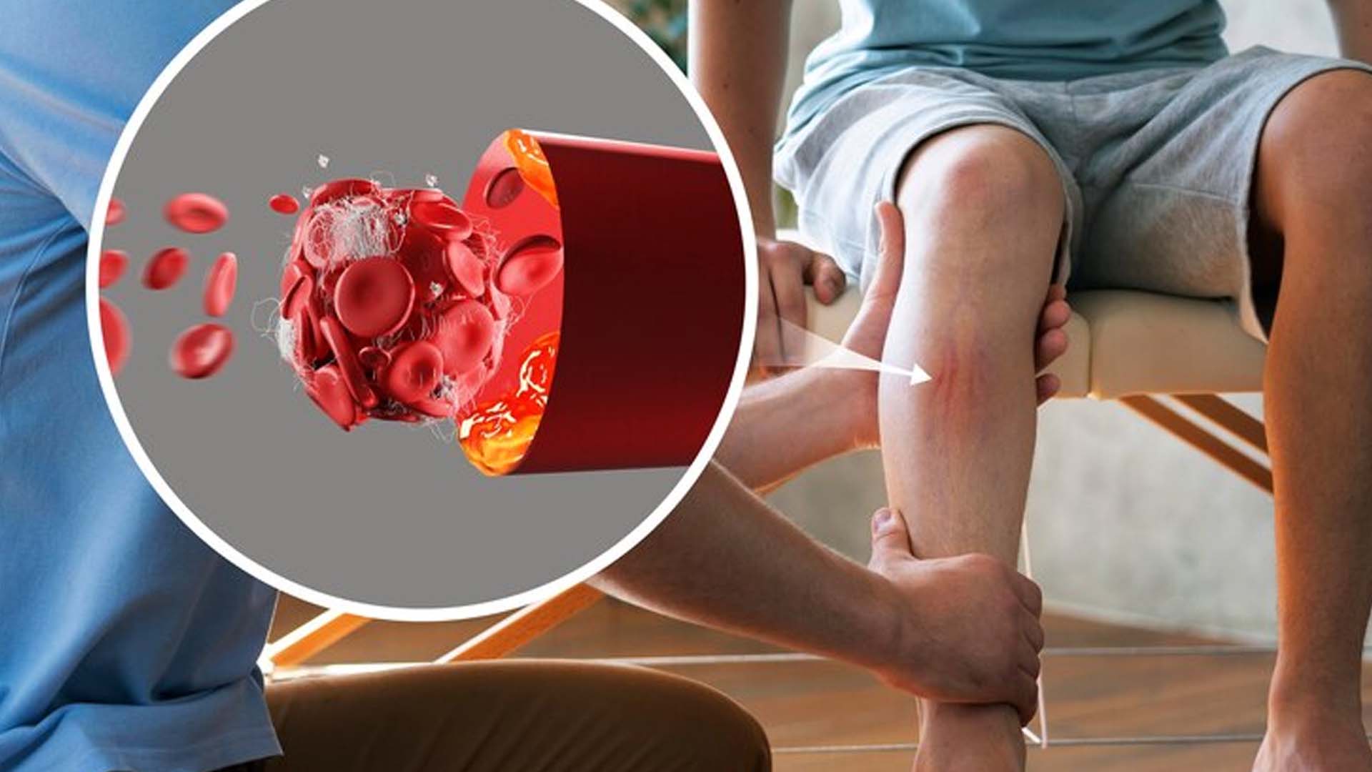 What are the Home Remedies for Deep Vein Thrombosis?