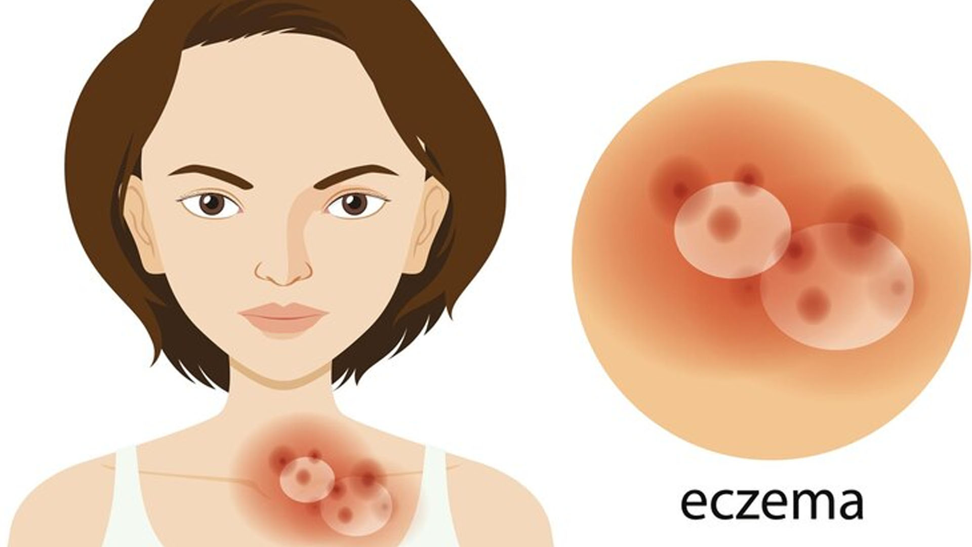 What are the Home Remedies for Eczema?