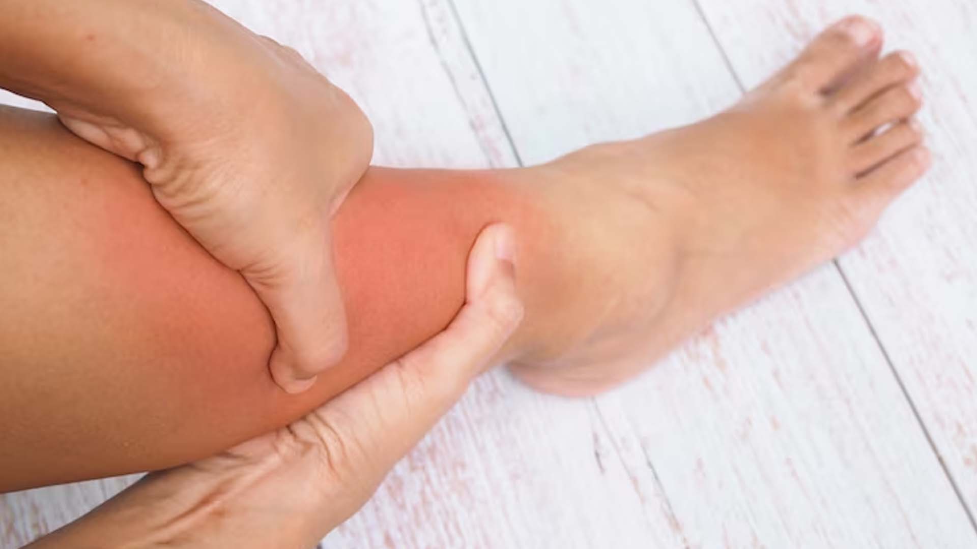 What are the Home Remedies for Edema?