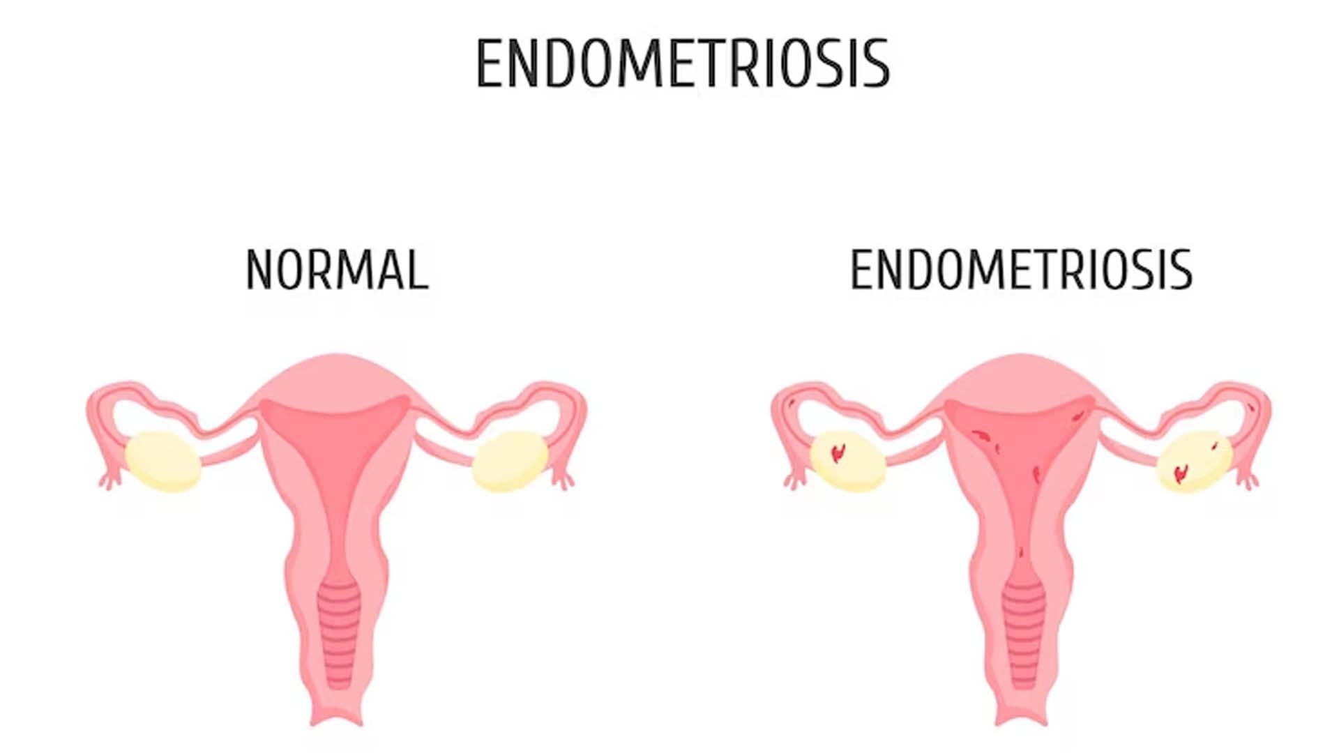 Endometriosis