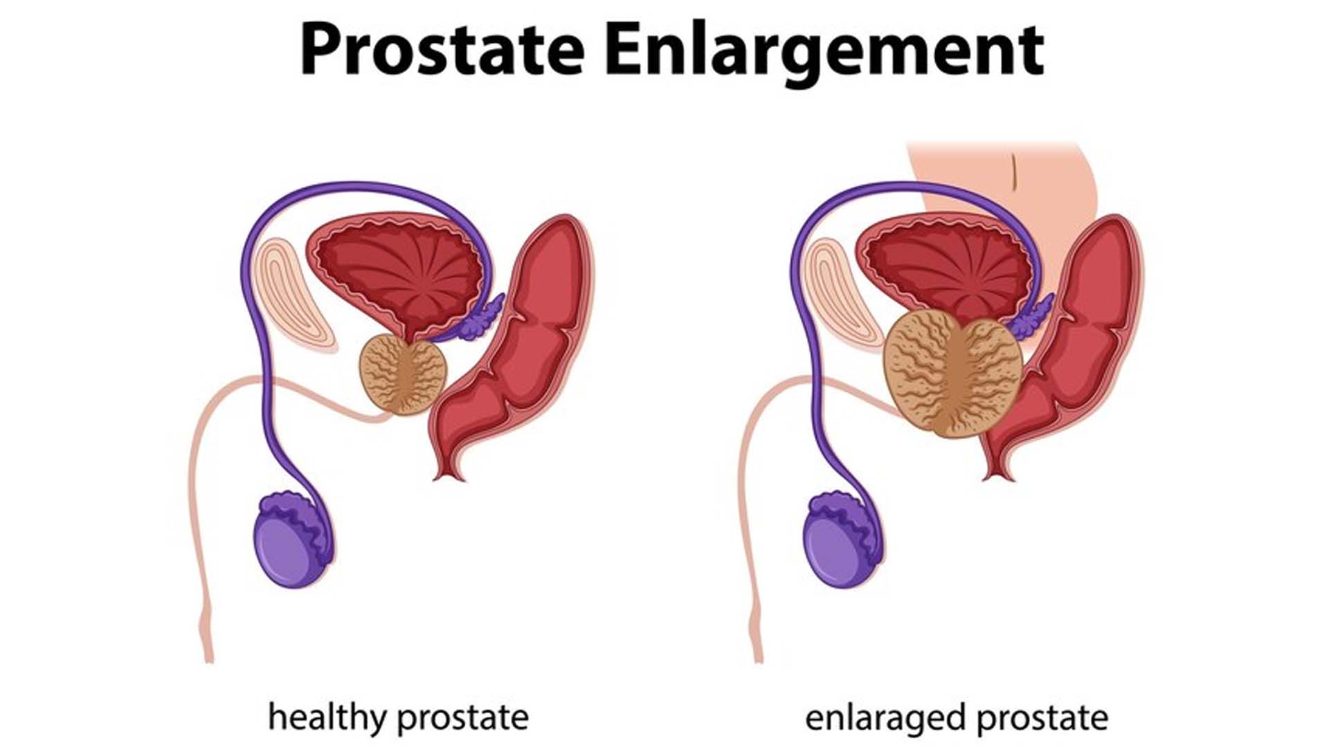 Enlarged Prostate