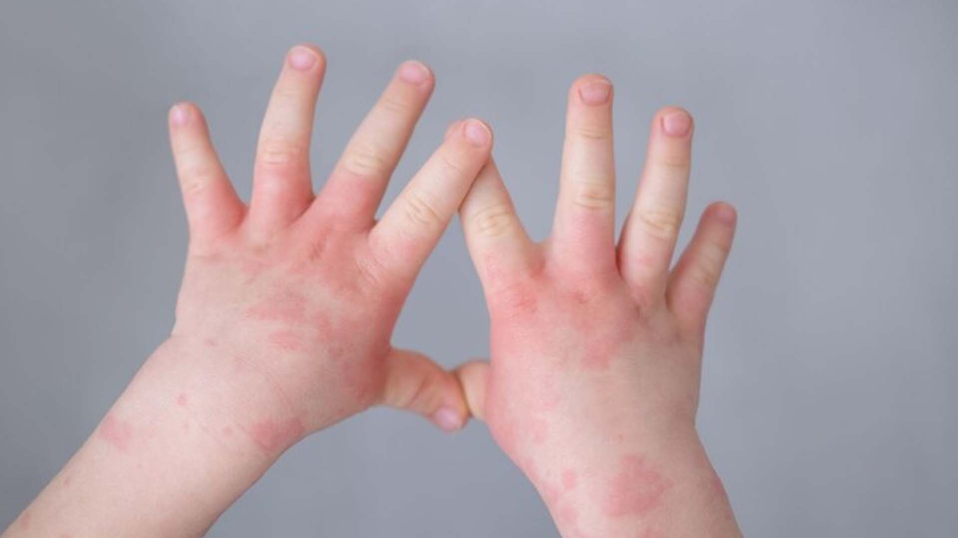 What are the Home Remedies for Eczema on Hands and Fingers?