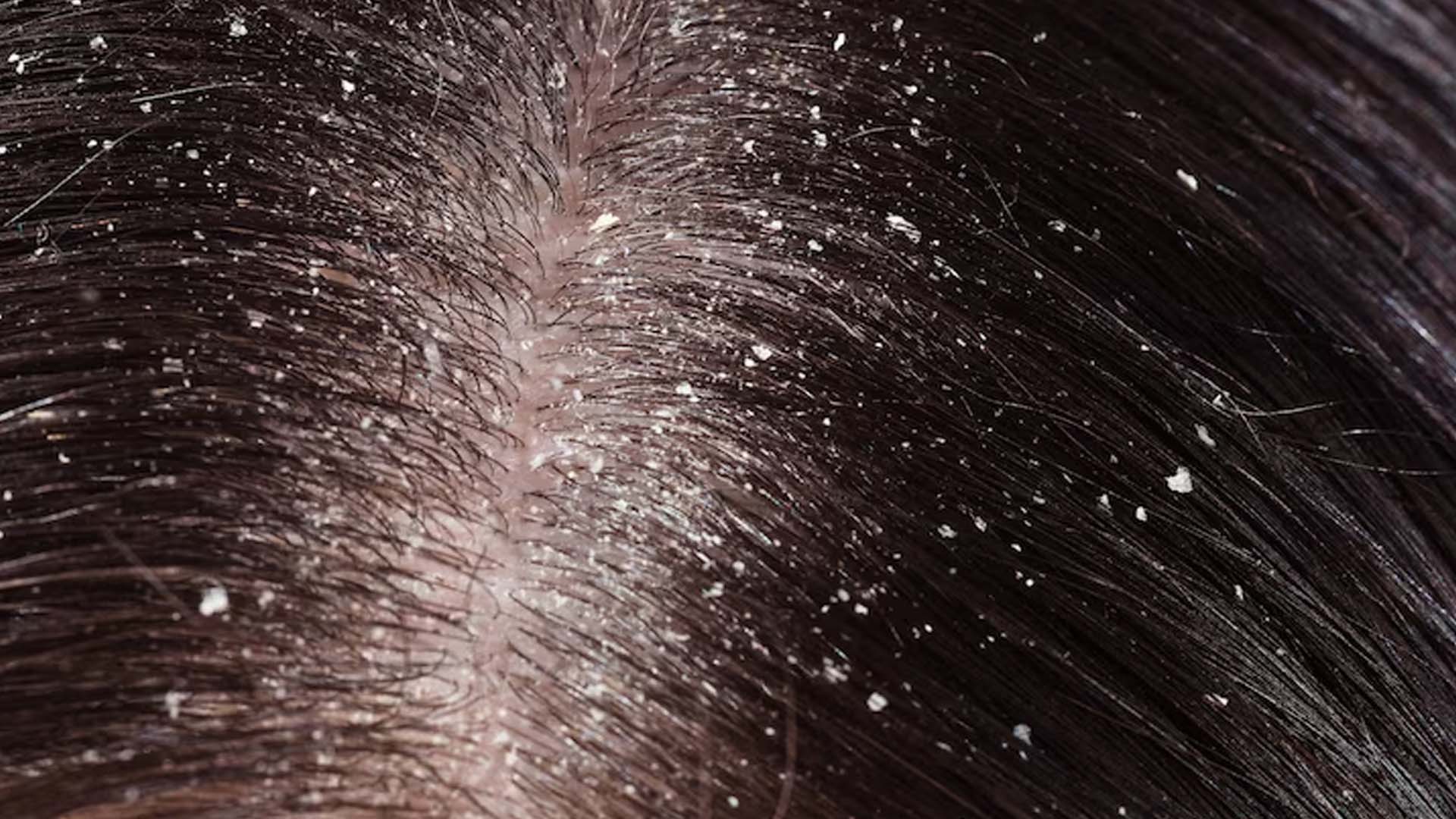 What are the Home Remedies for Flaky Scalp?