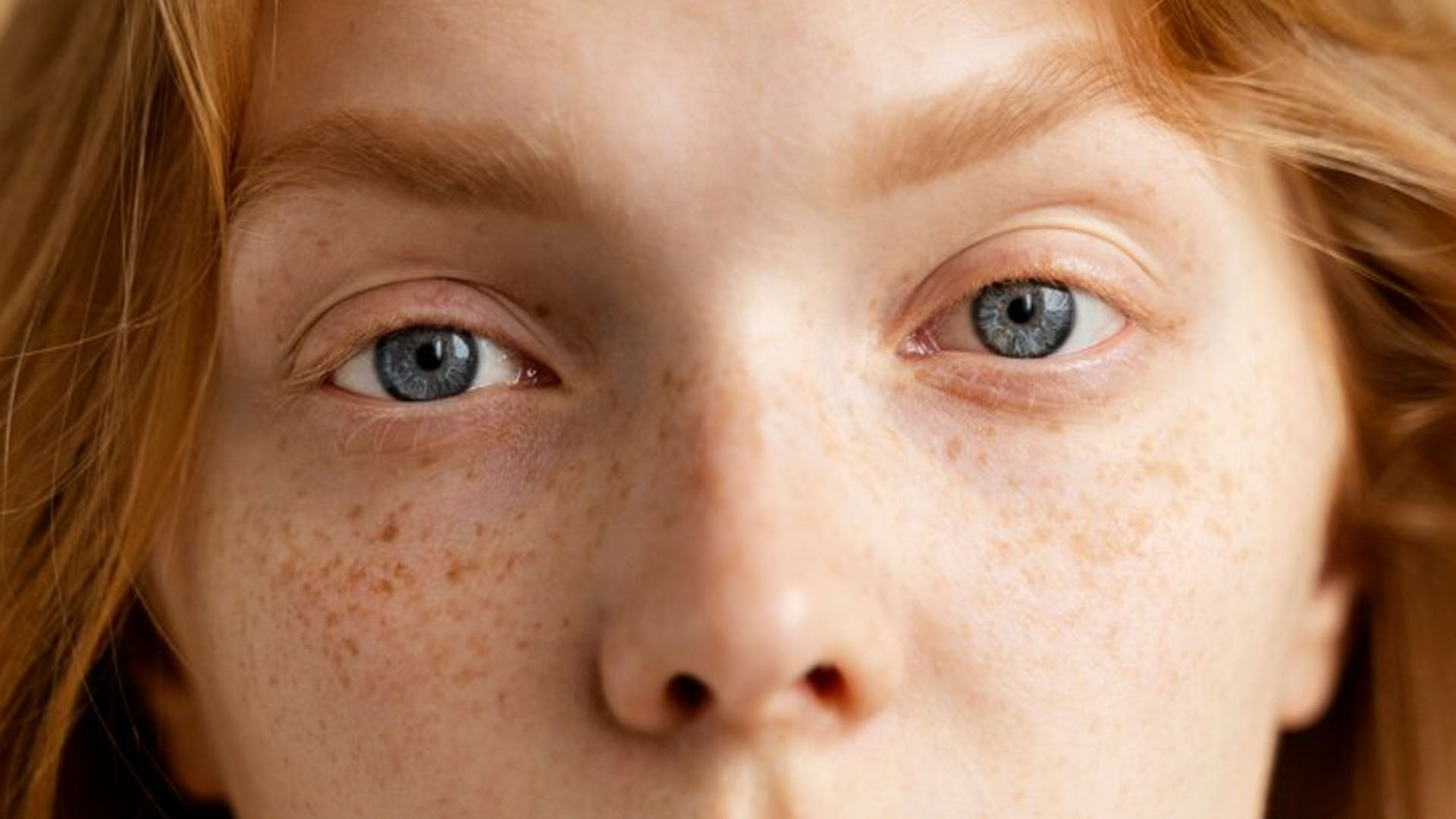 What are the Home Remedies for Freckles?