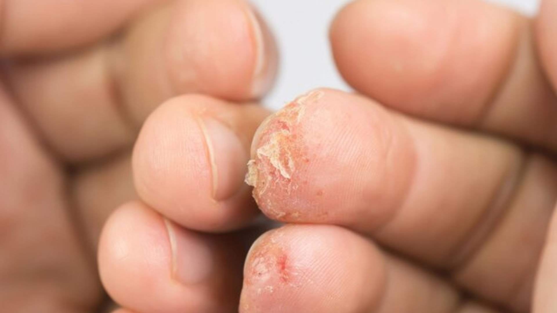 What are the Home Remedies for Fungal Nail Infection?