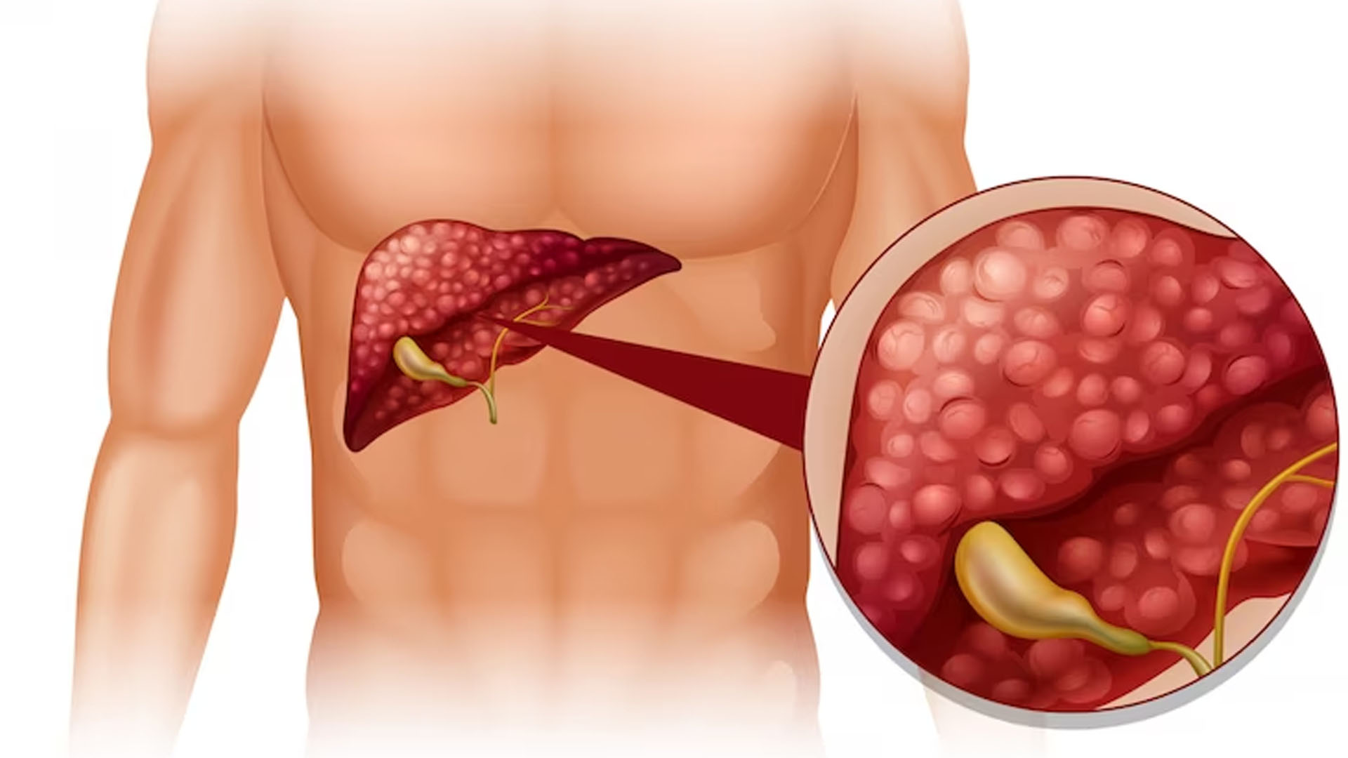 What are the Home Remedies for Gallstones?
