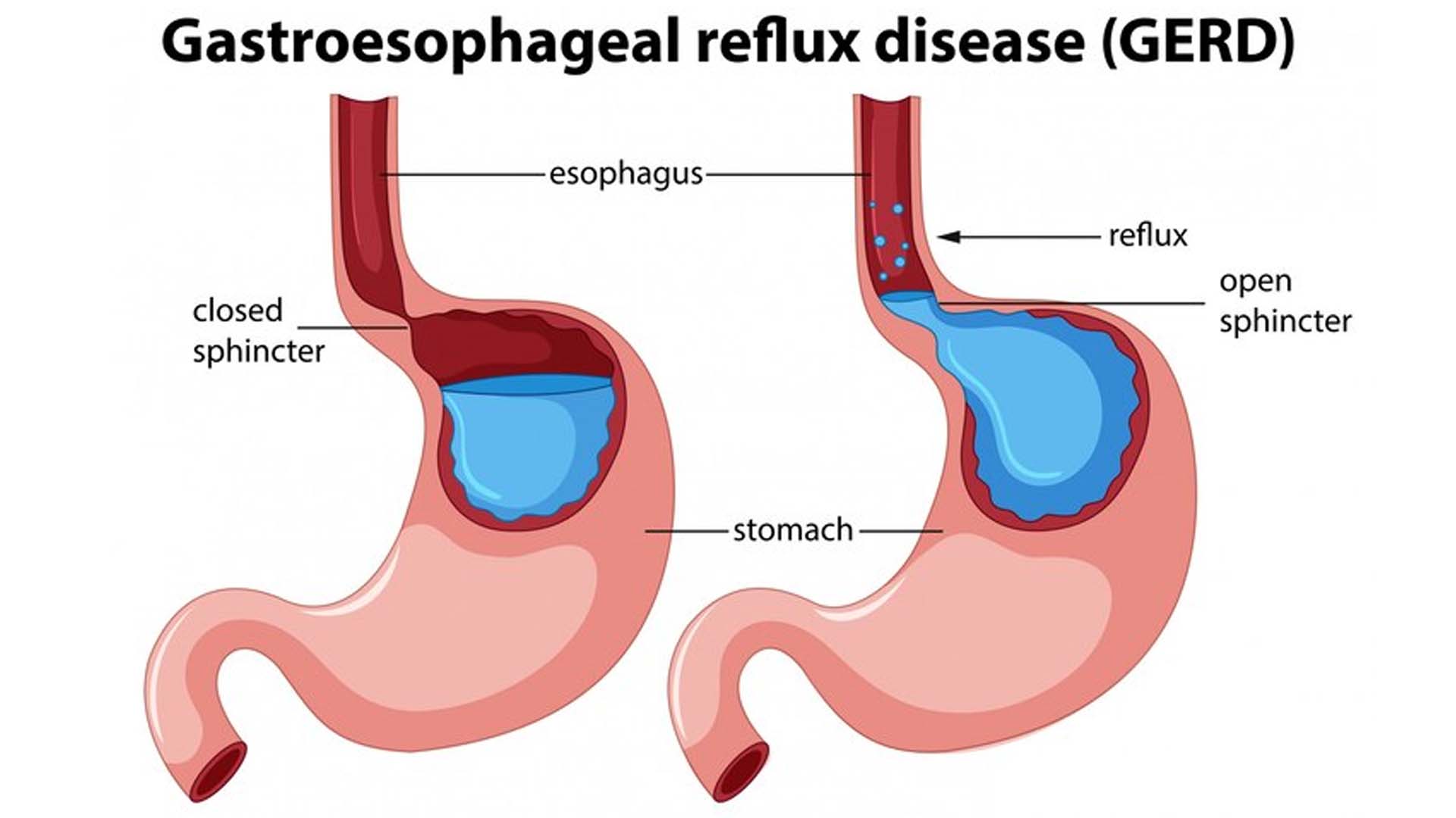 Gastroesophageal reflux disease (GERD)