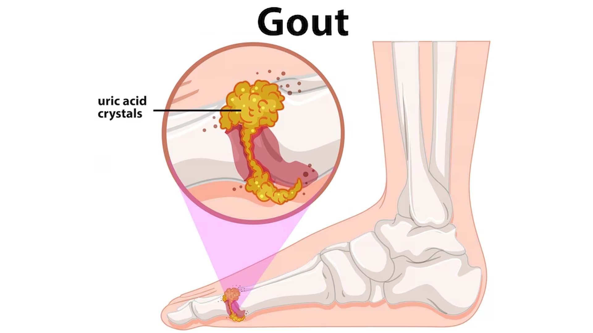 Gout (inflammatory arthritis)