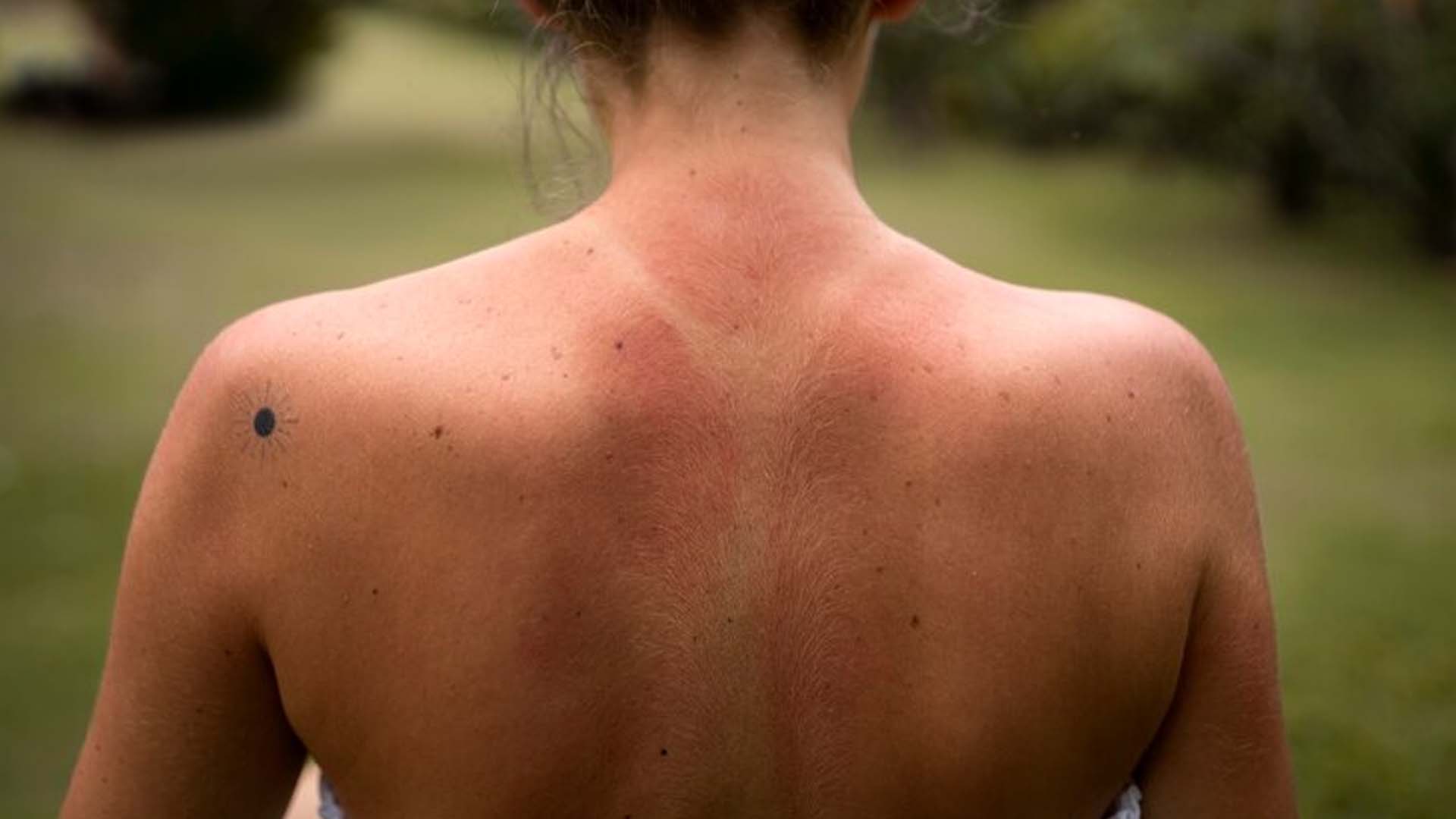 What are the Home Remedies for Heat Rash?