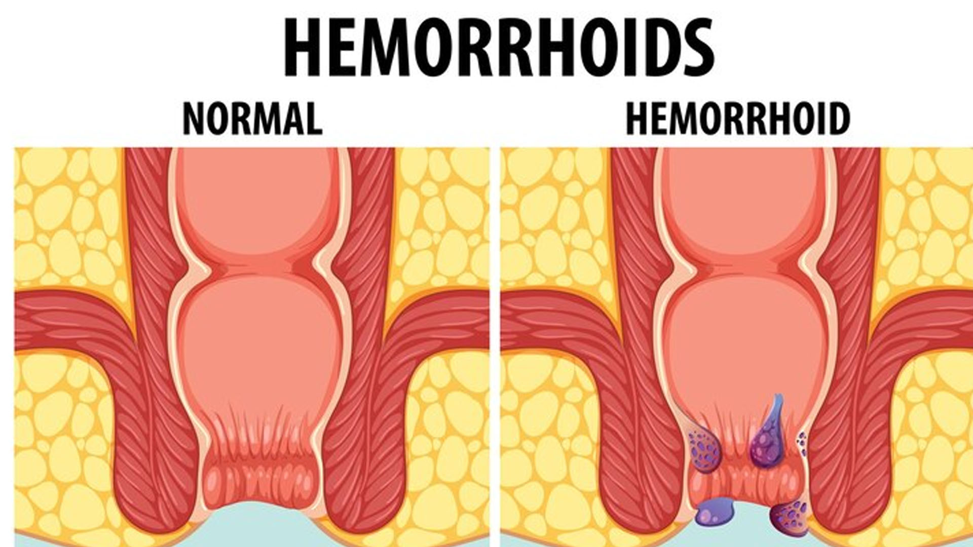 What are the Home Remedies for Hemorrhoids?