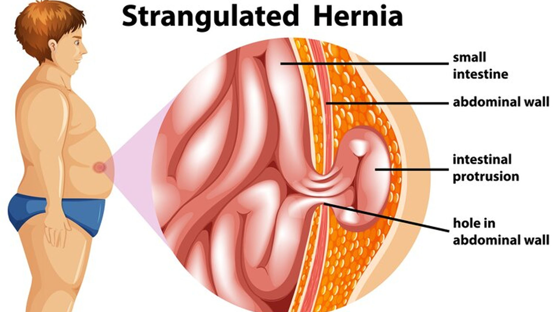 What are the Home Remedies for Hernia?