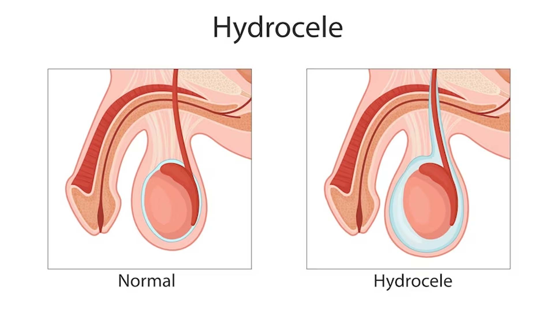 What are the Home Remedies for Hydrocele?